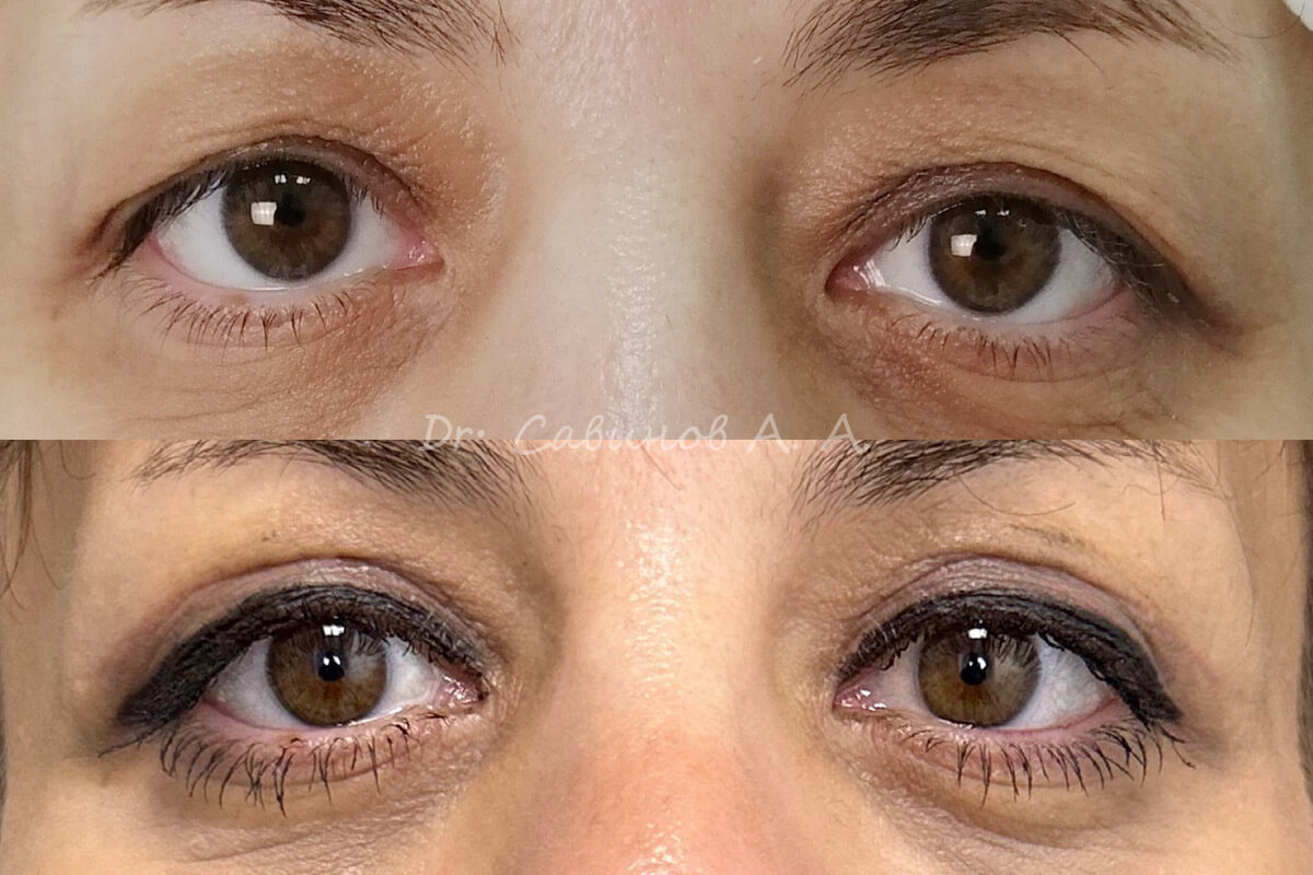 Нижняя блефаропластика 01