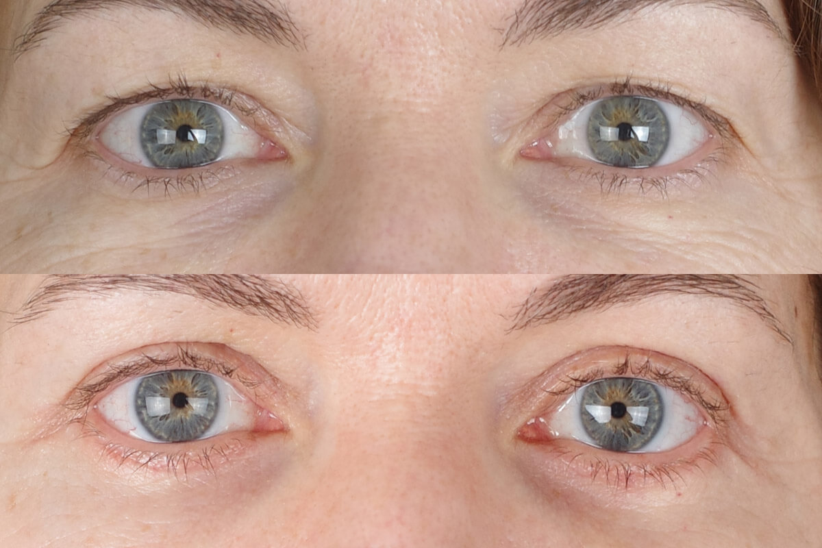 Нижняя блефаропластика 01