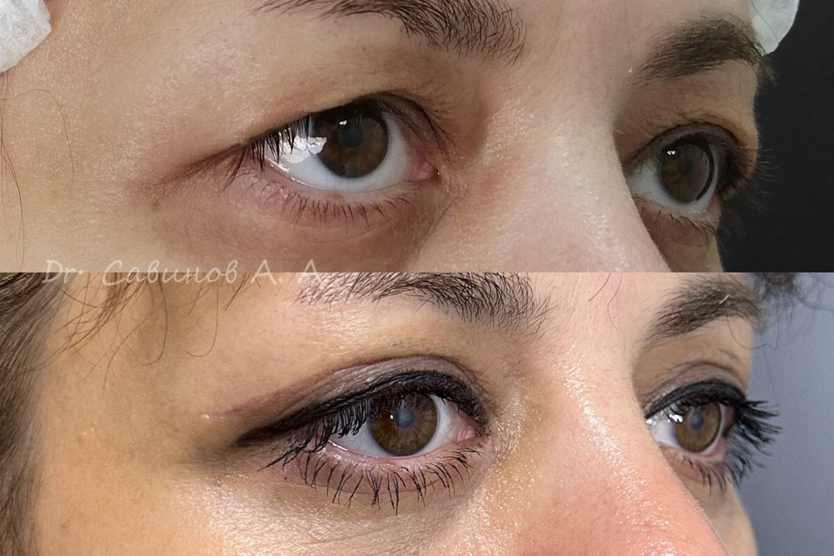 Нижняя блефаропластика 01