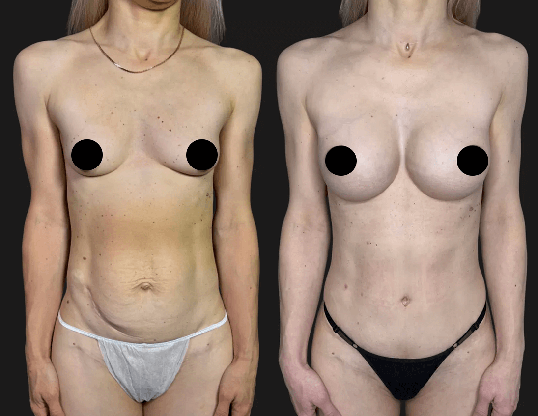 Увеличение груди имплантами 01