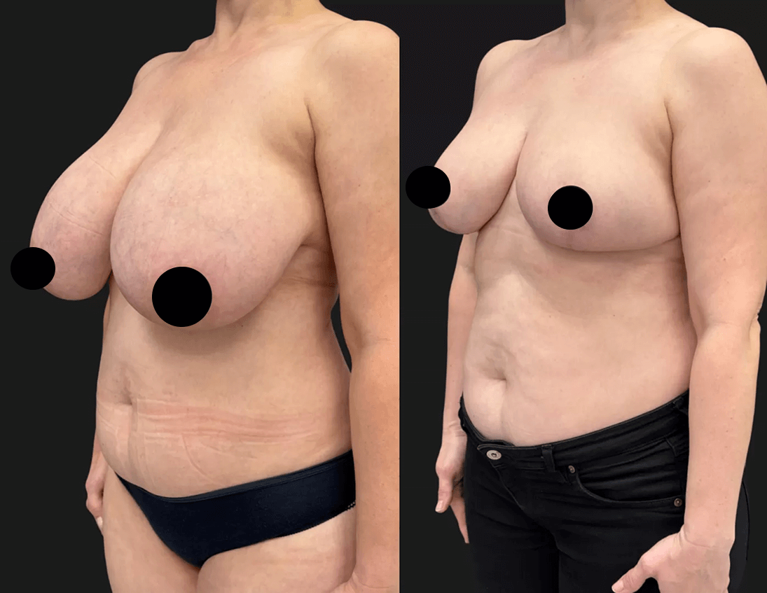 Уменьшение груди (редукция) 01