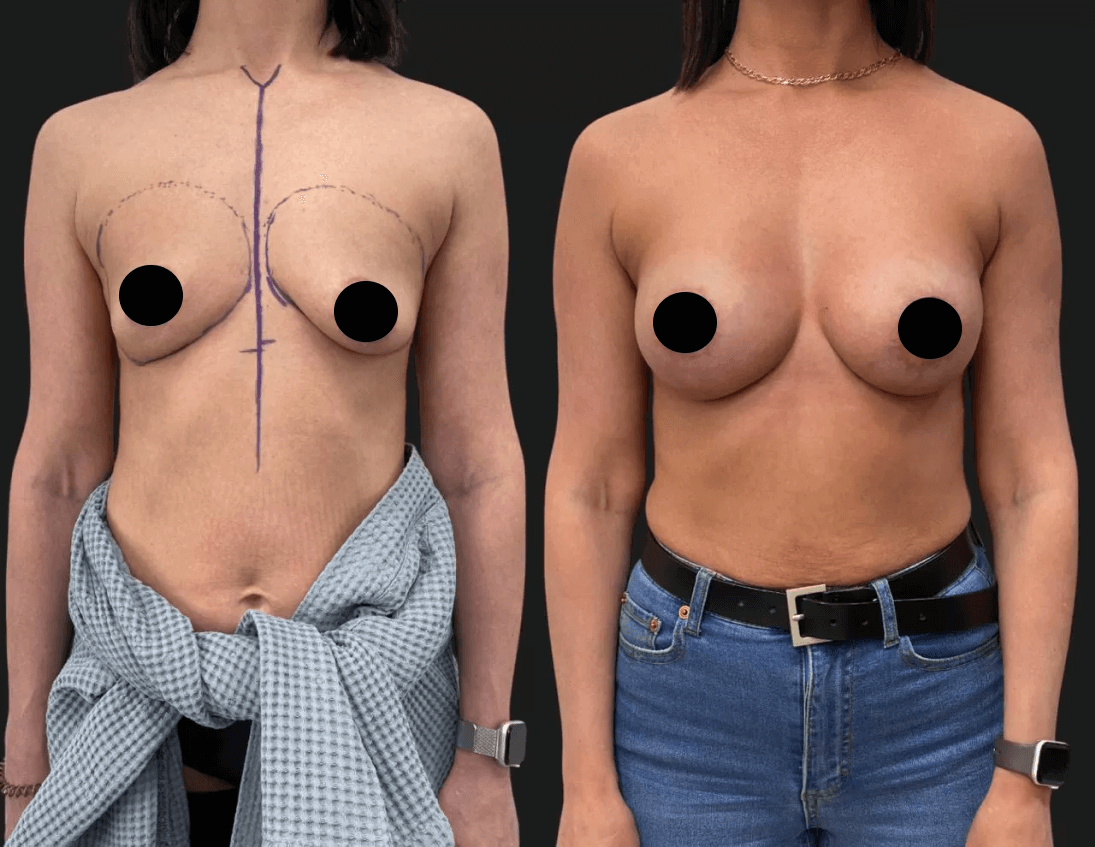 Увеличение груди имплантами 01