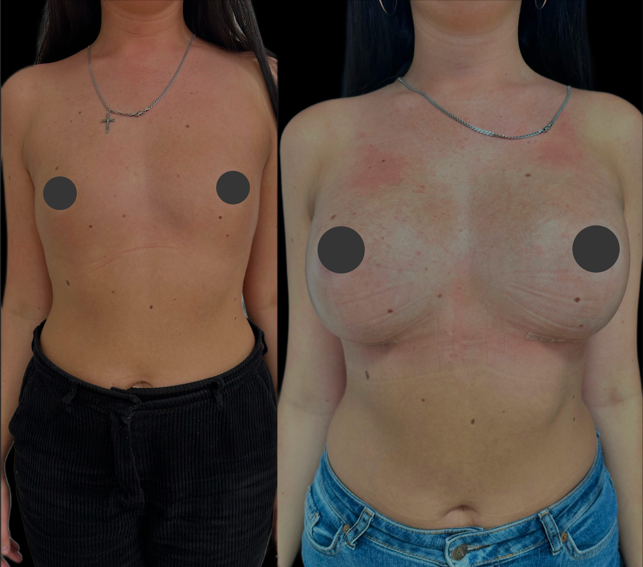 Увеличение груди имплантами 01