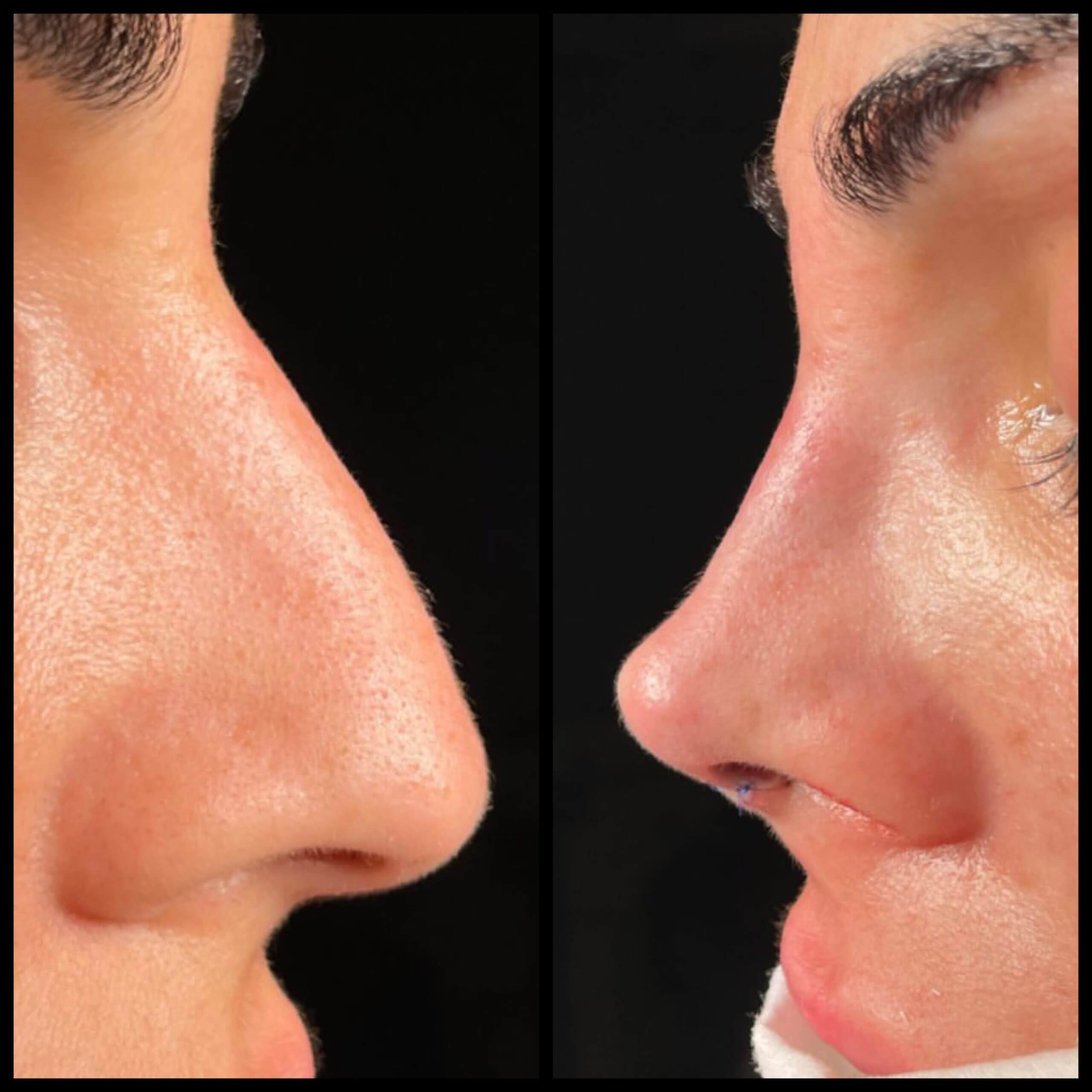 Ринопластика 01