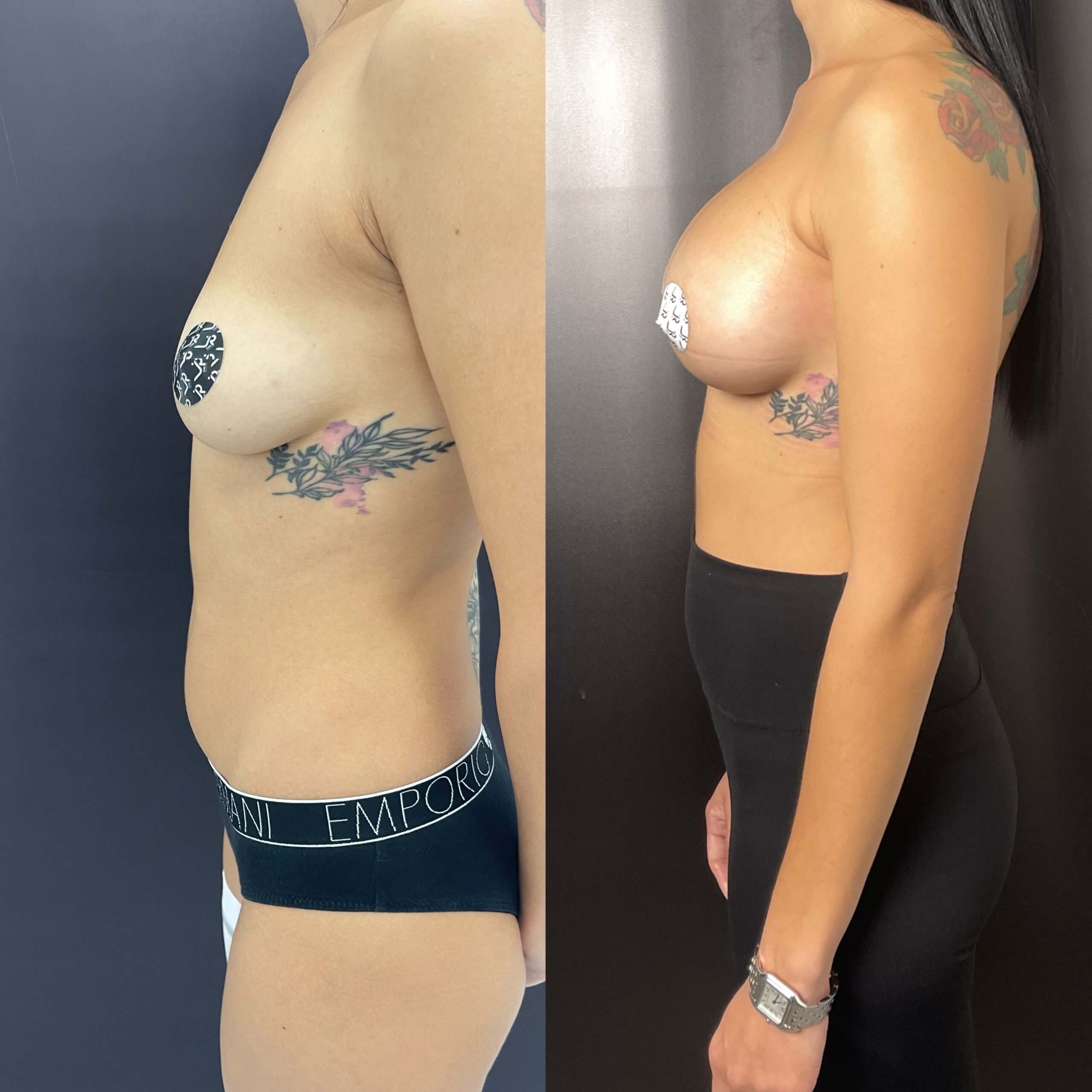 Увеличение груди имплантами 01