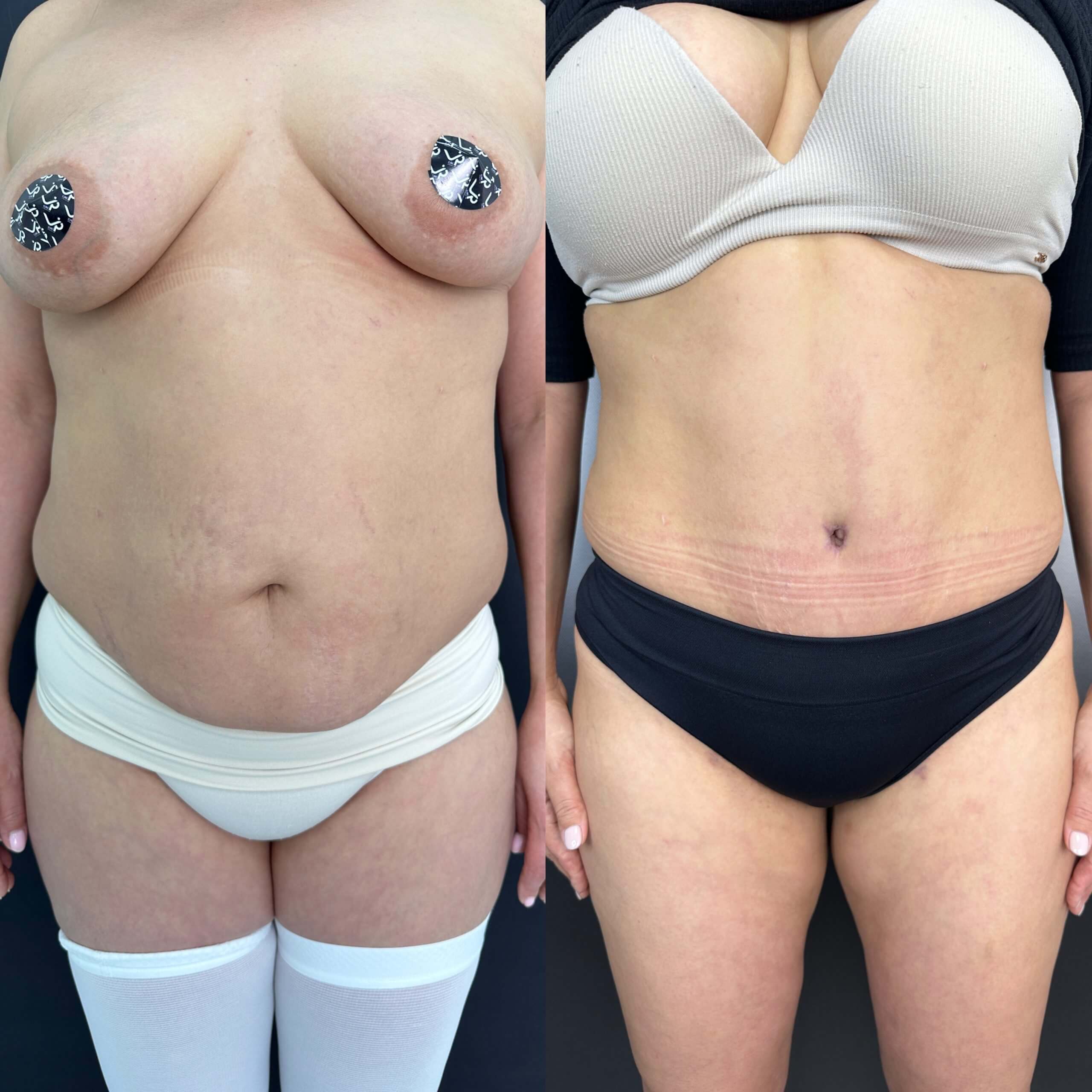 Ушивание диастаза 01