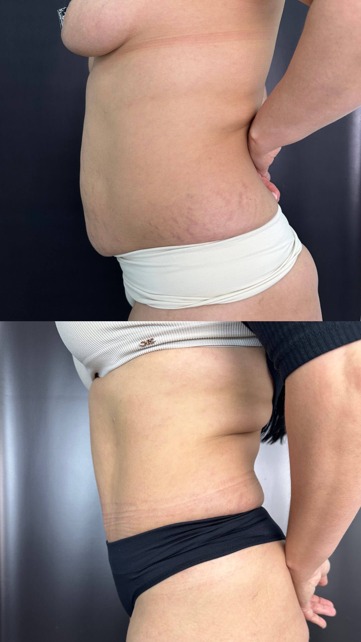 Ушивание диастаза 01