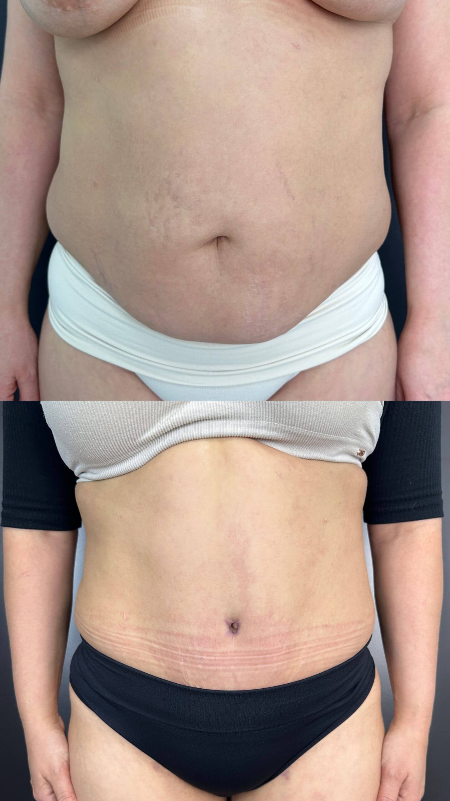 Ушивание диастаза 01