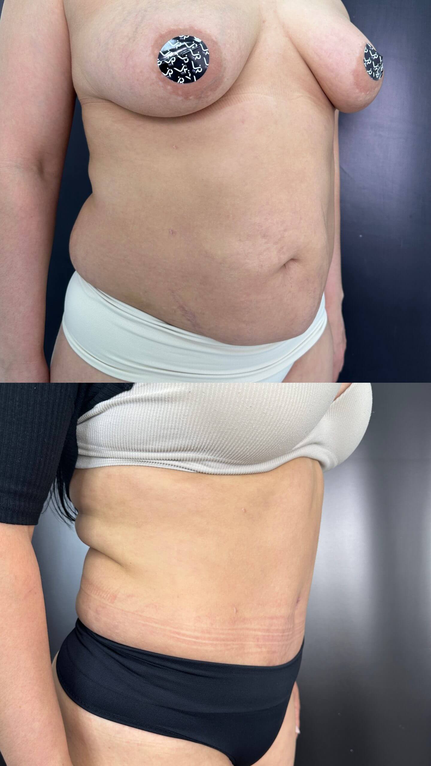 Ушивание диастаза 01