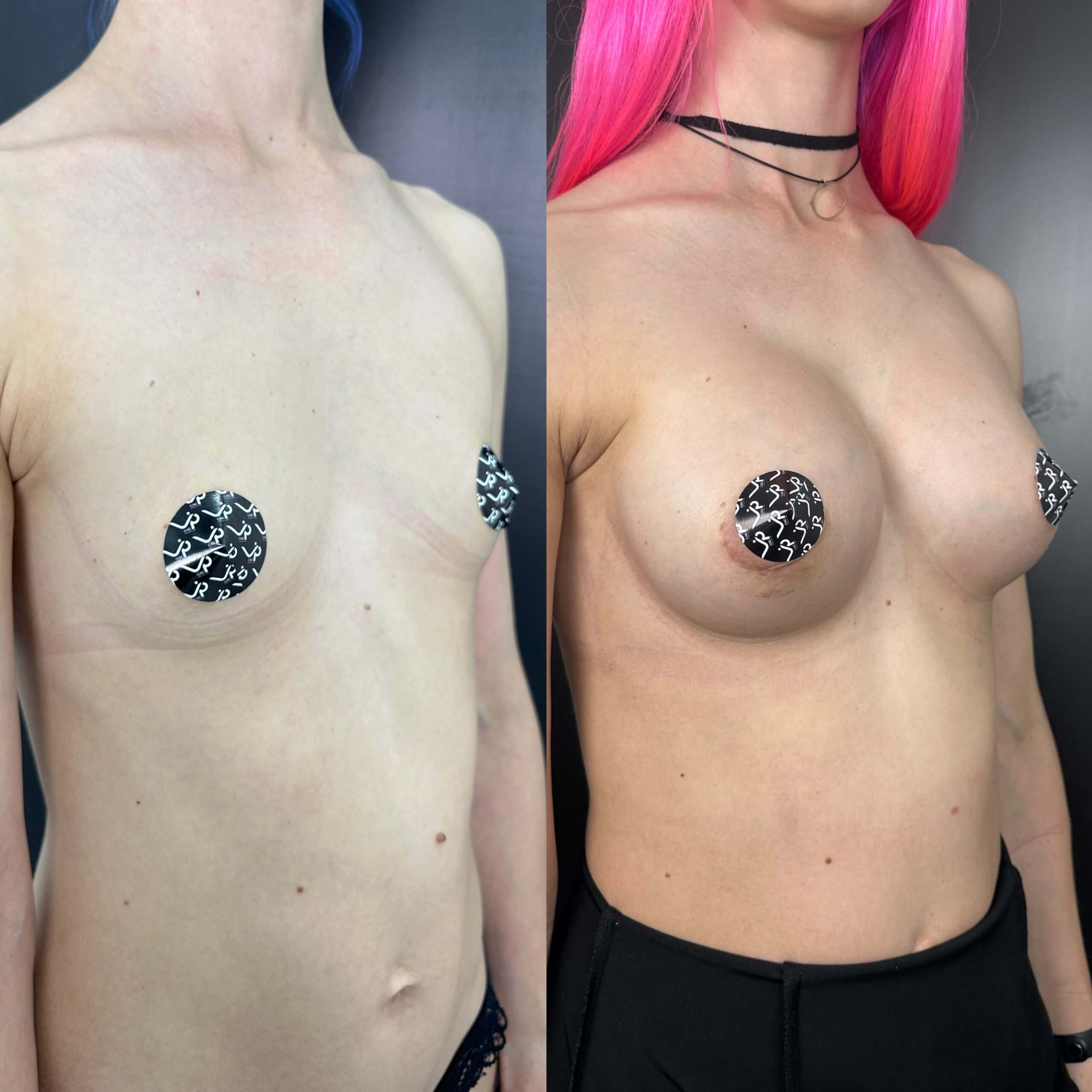 Увеличение груди имплантами 01