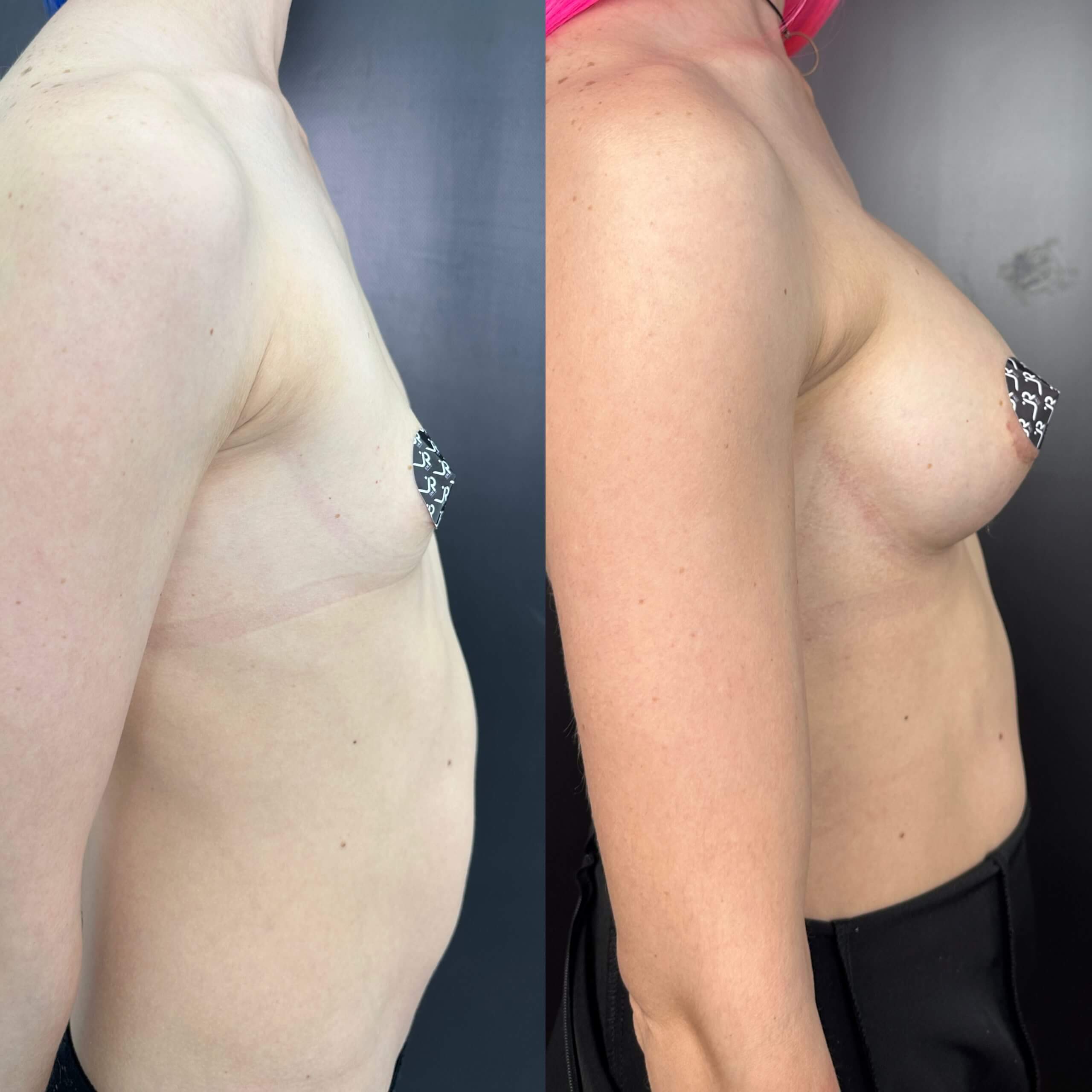 Увеличение груди имплантами 01