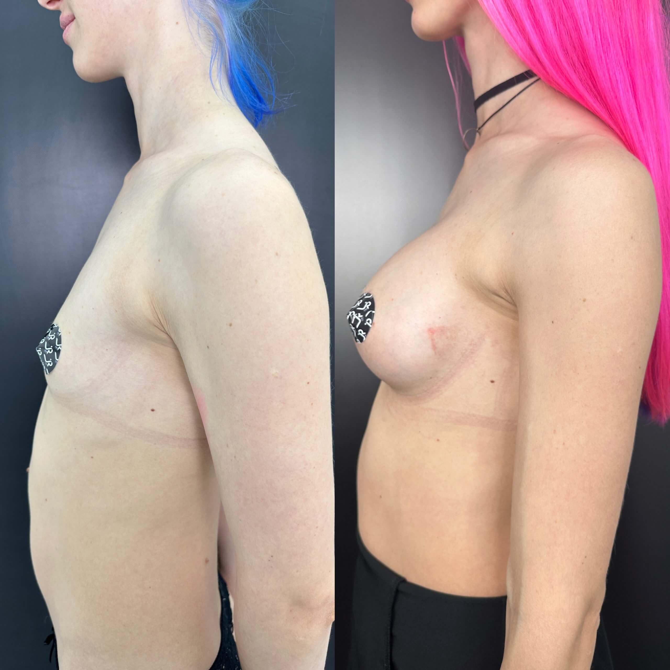 Увеличение груди имплантами 01