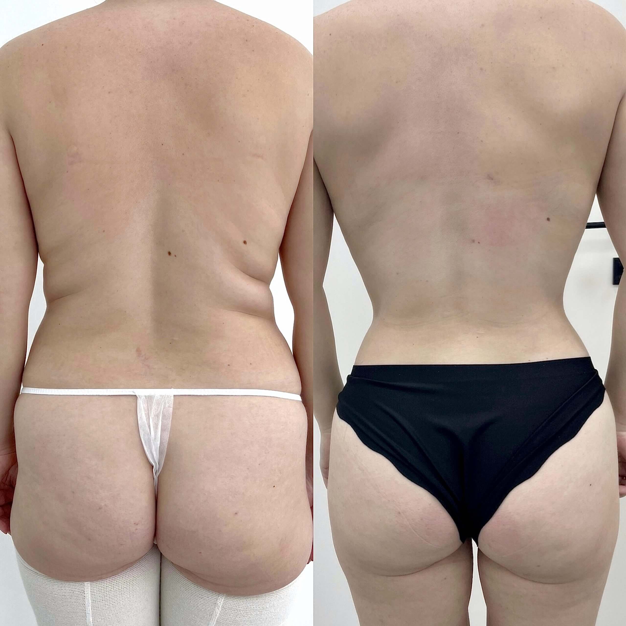 Липосакция спины 01