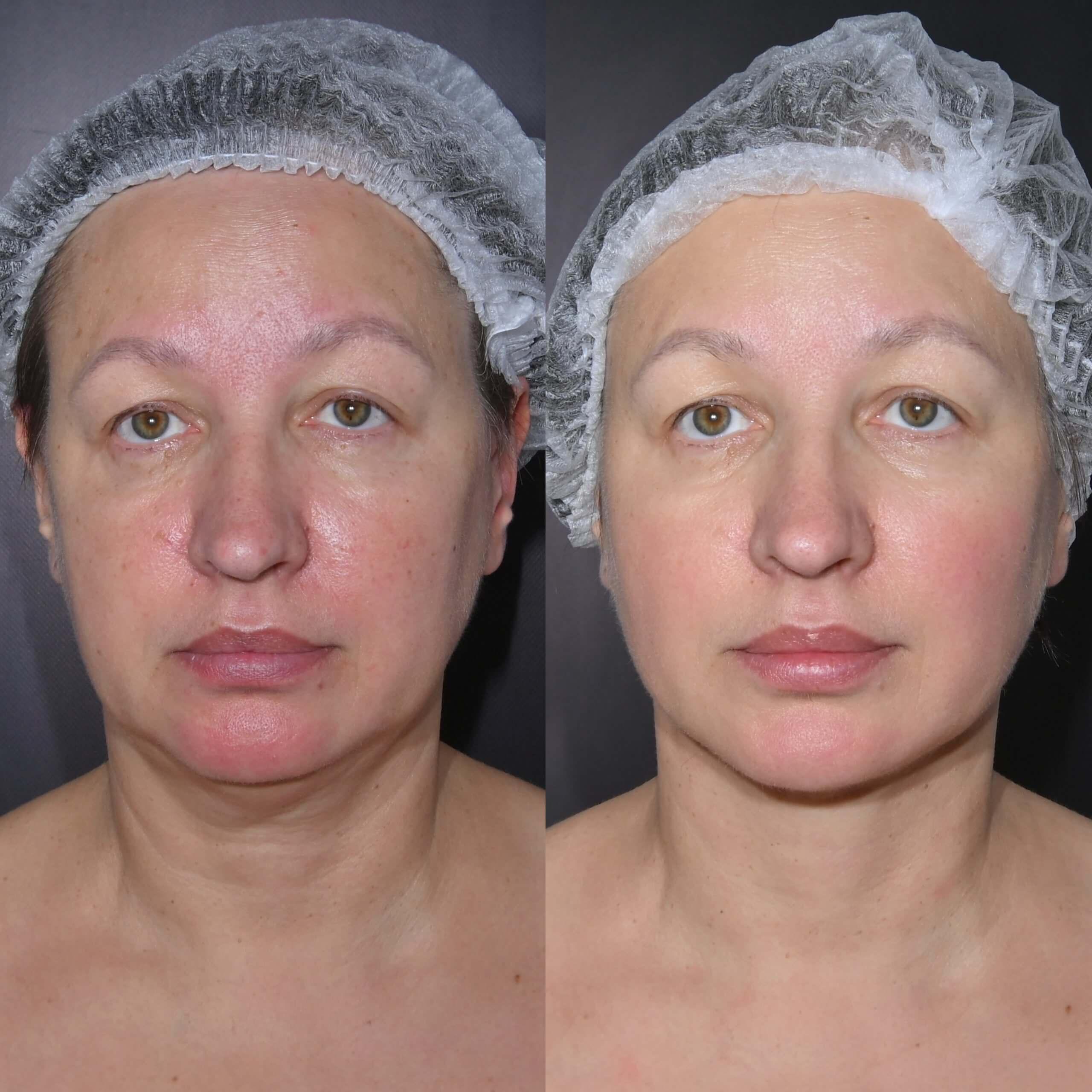 Нитевой лифтинг лица 01