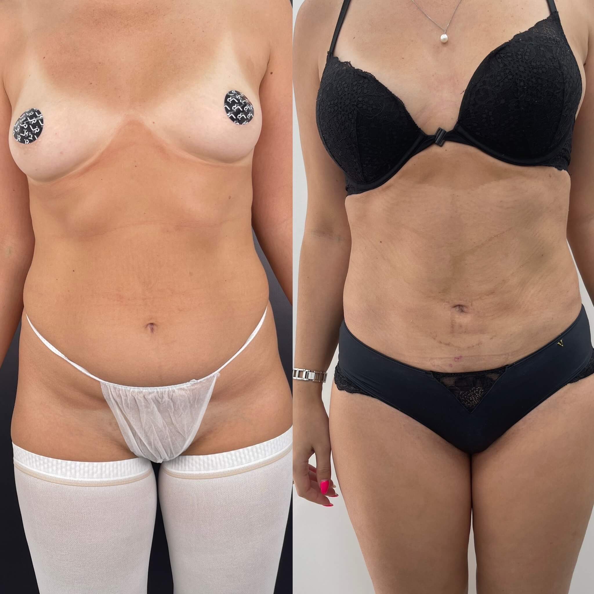 Липомоделирование тела 01