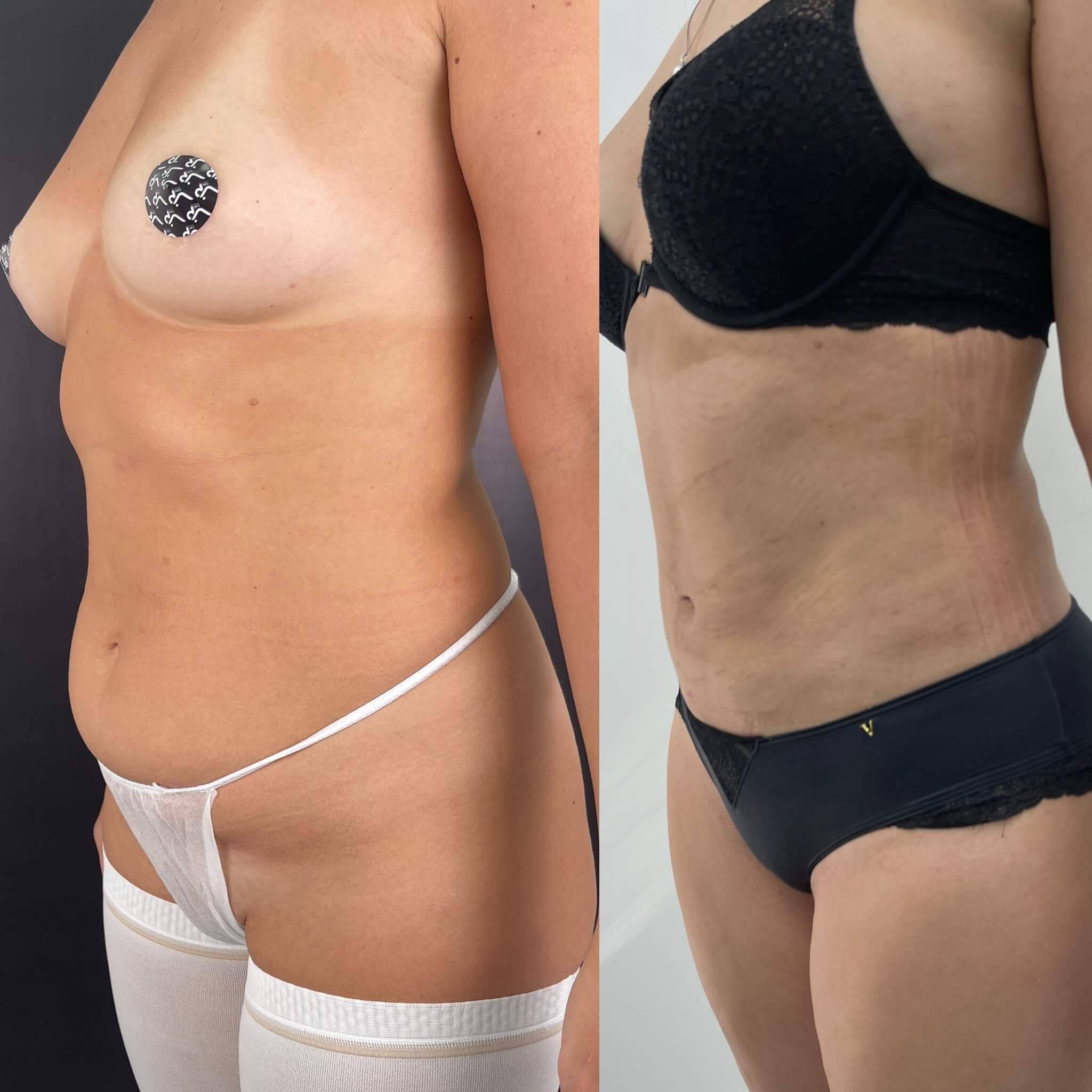 Липомоделирование тела 01