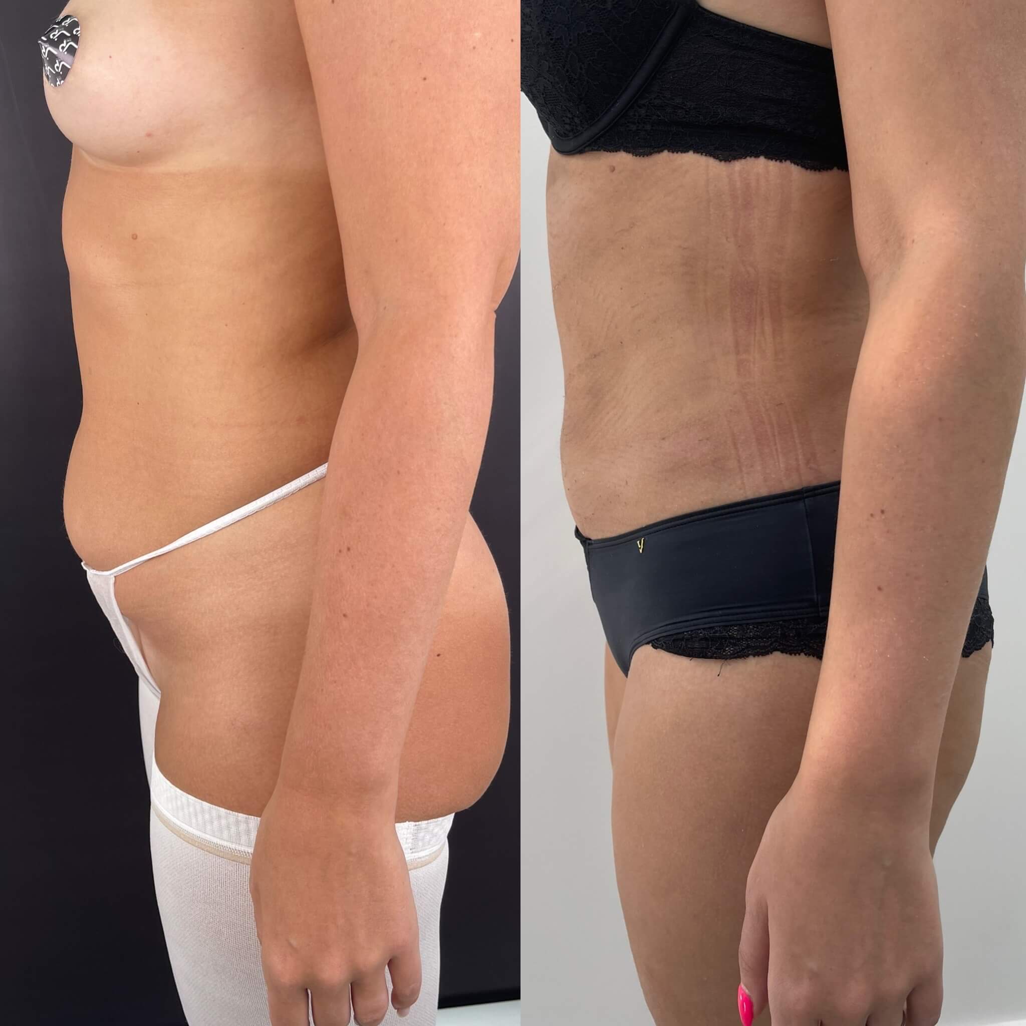 Липомоделирование тела 01