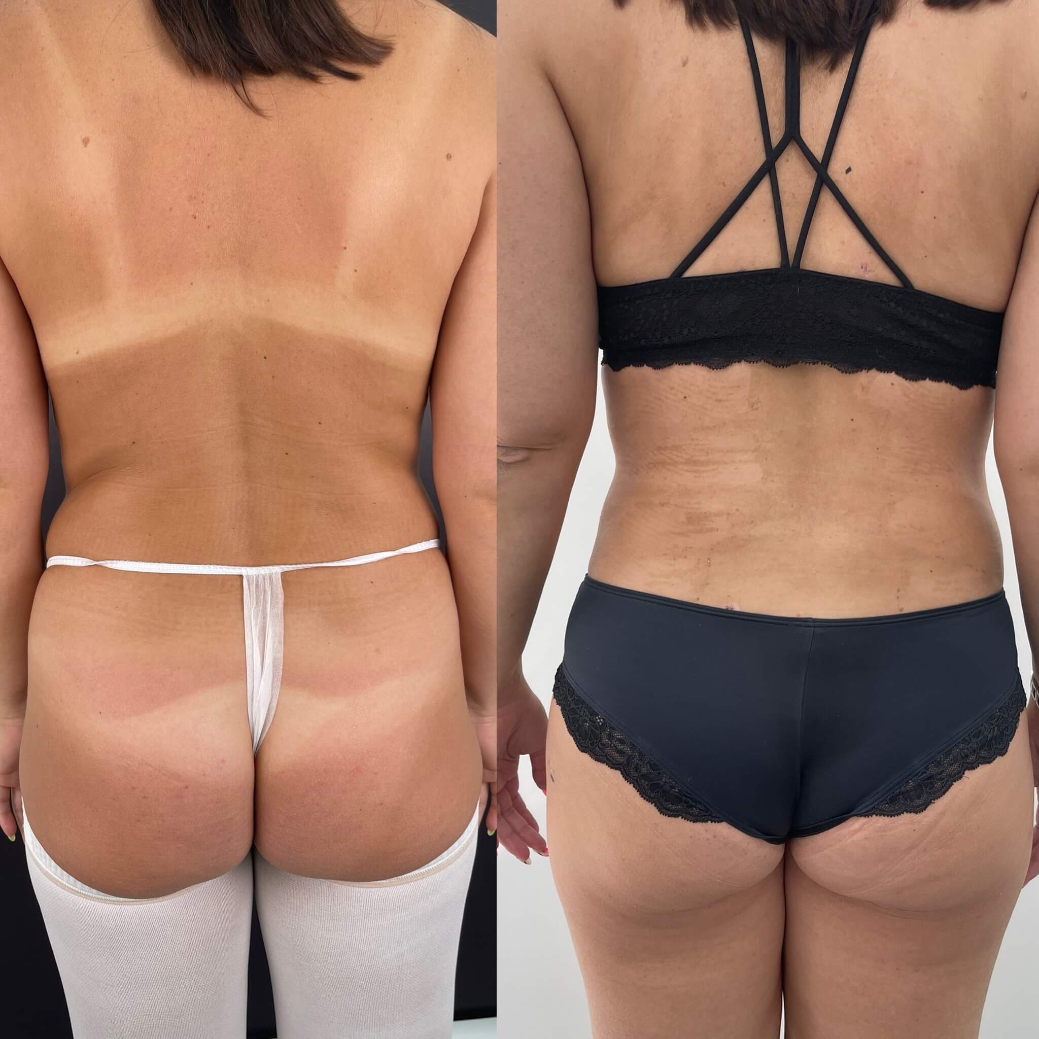 Липомоделирование тела 01