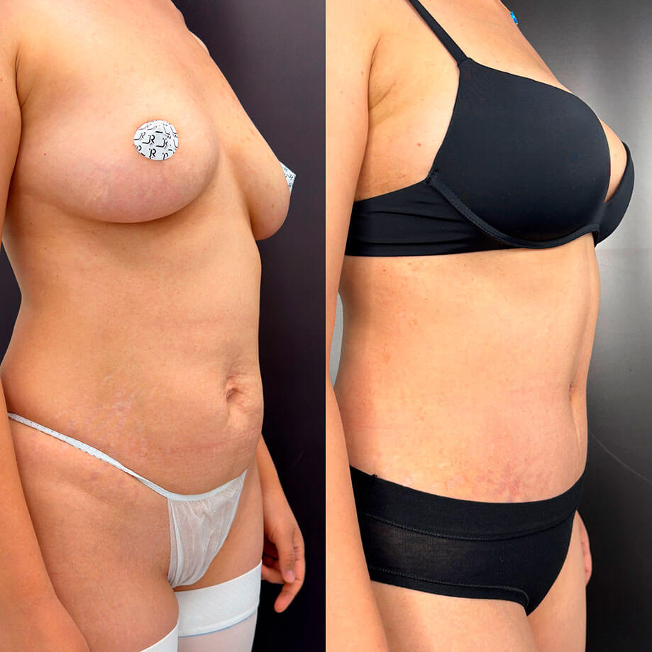 Абдоминопластика с переносом пупка 01