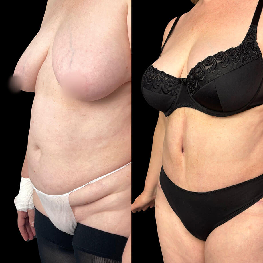 Абдоминопластика с переносом пупка 01