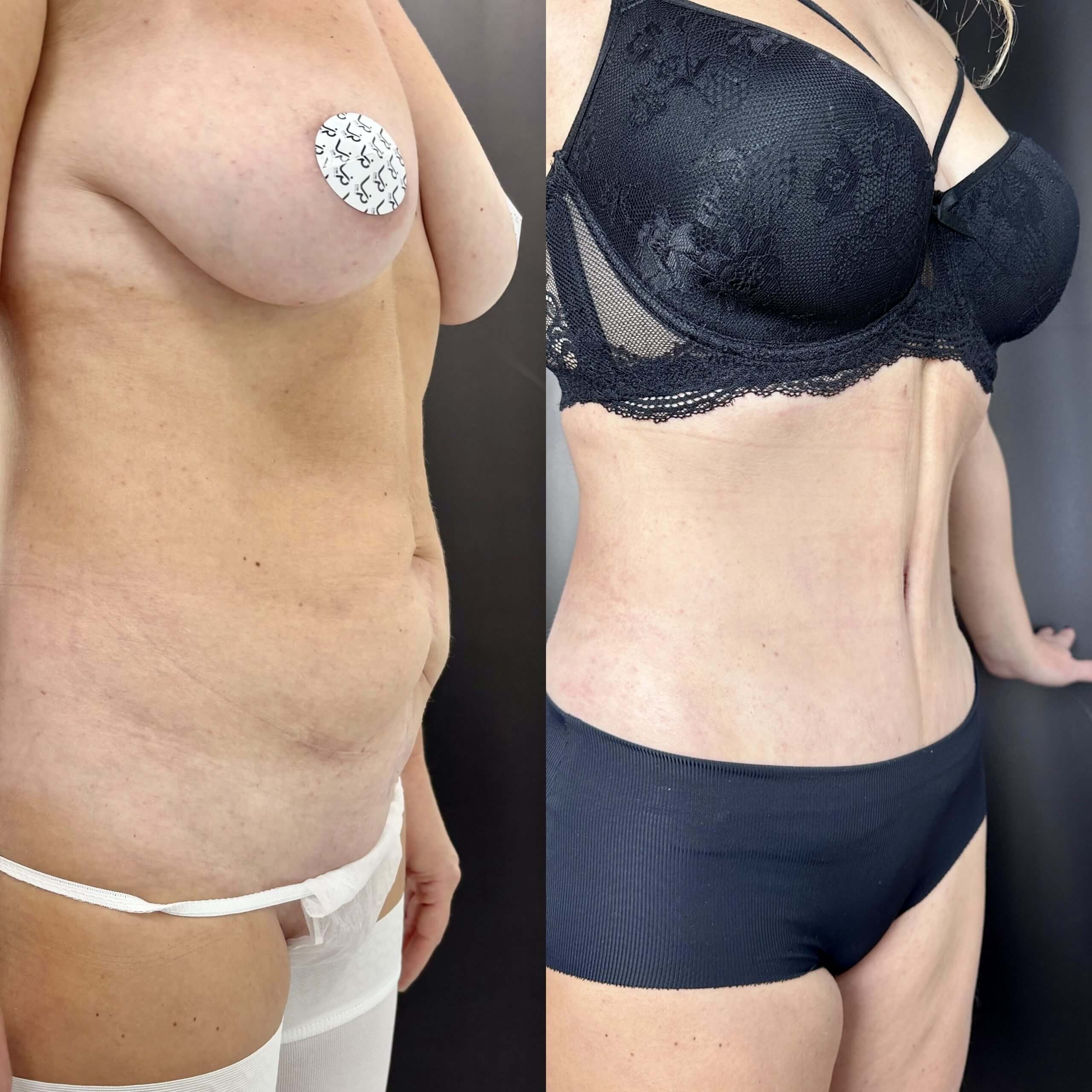 Ушивание диастаза 01