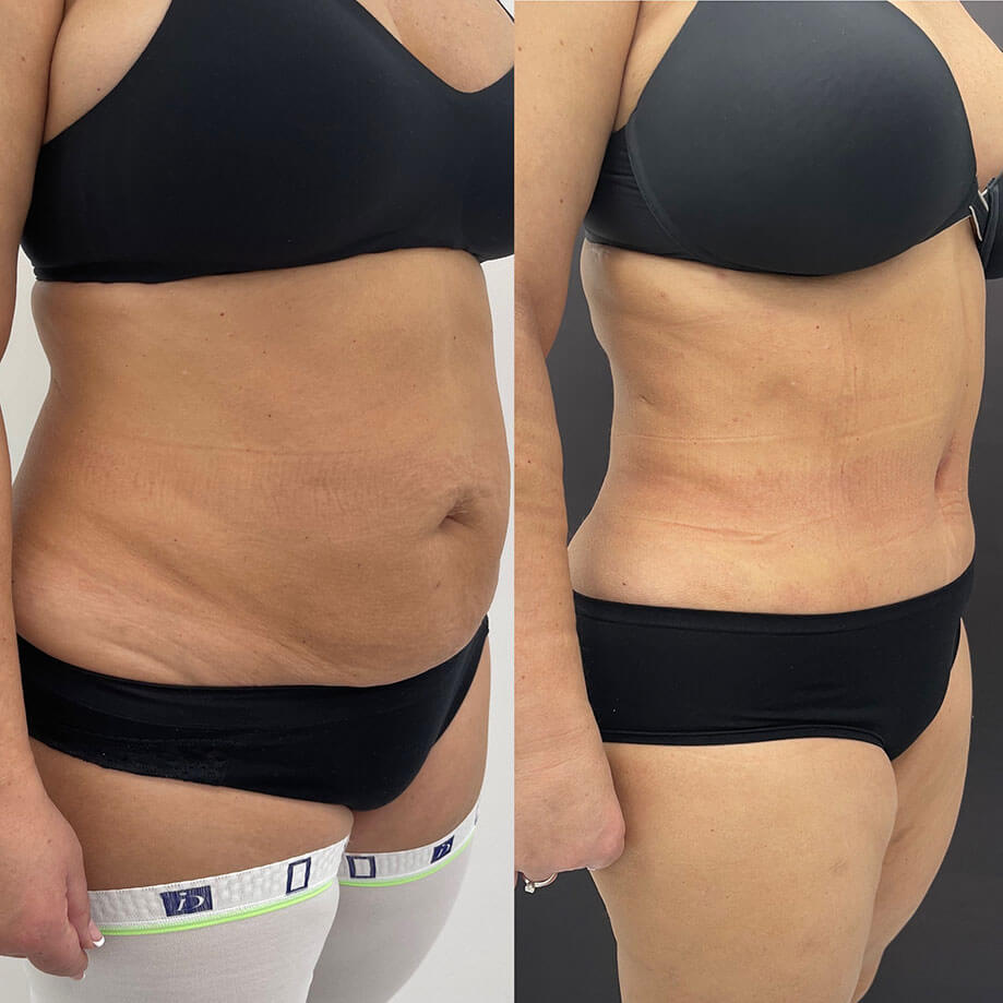 Абдоминопластика с переносом пупка 01