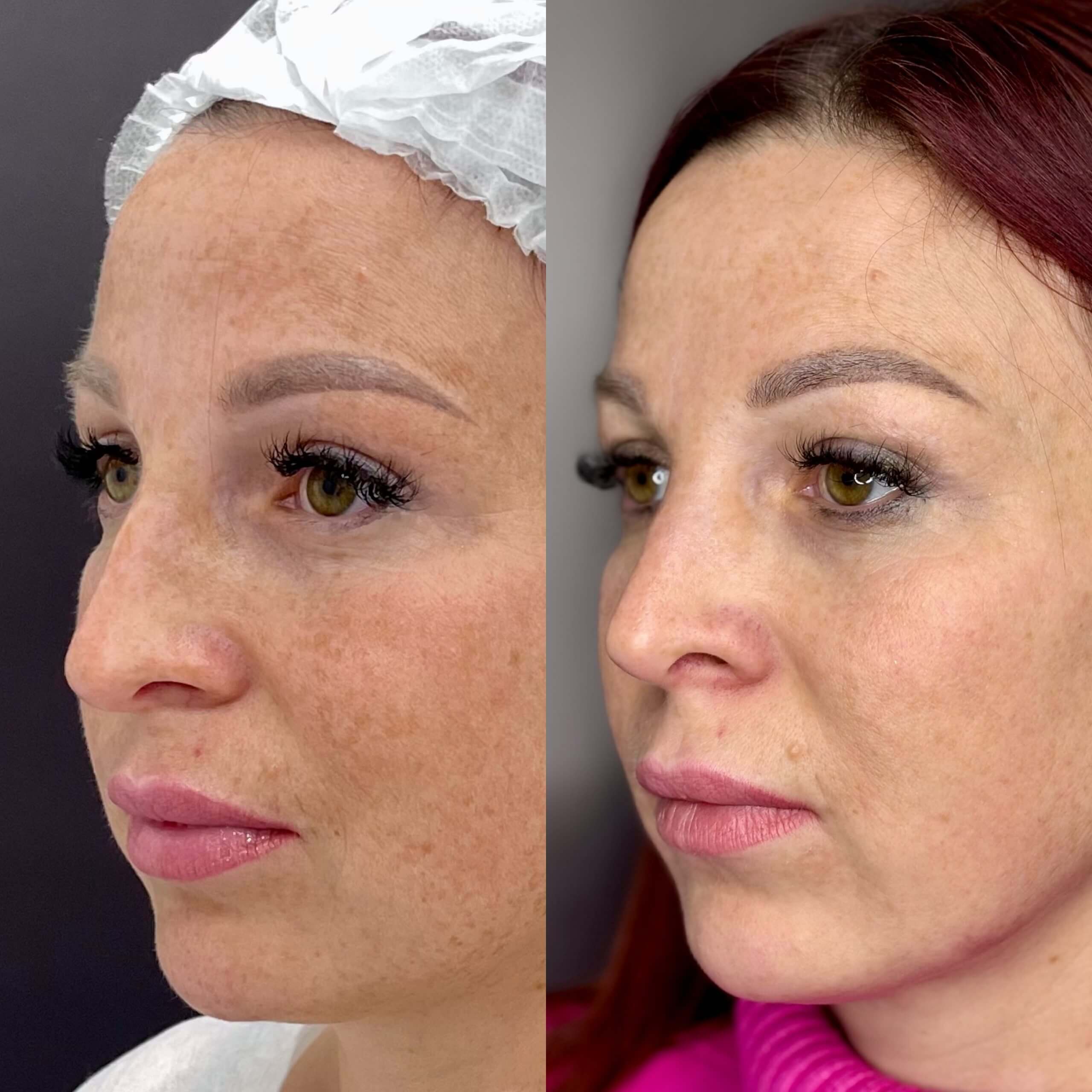 Ринопластика 01