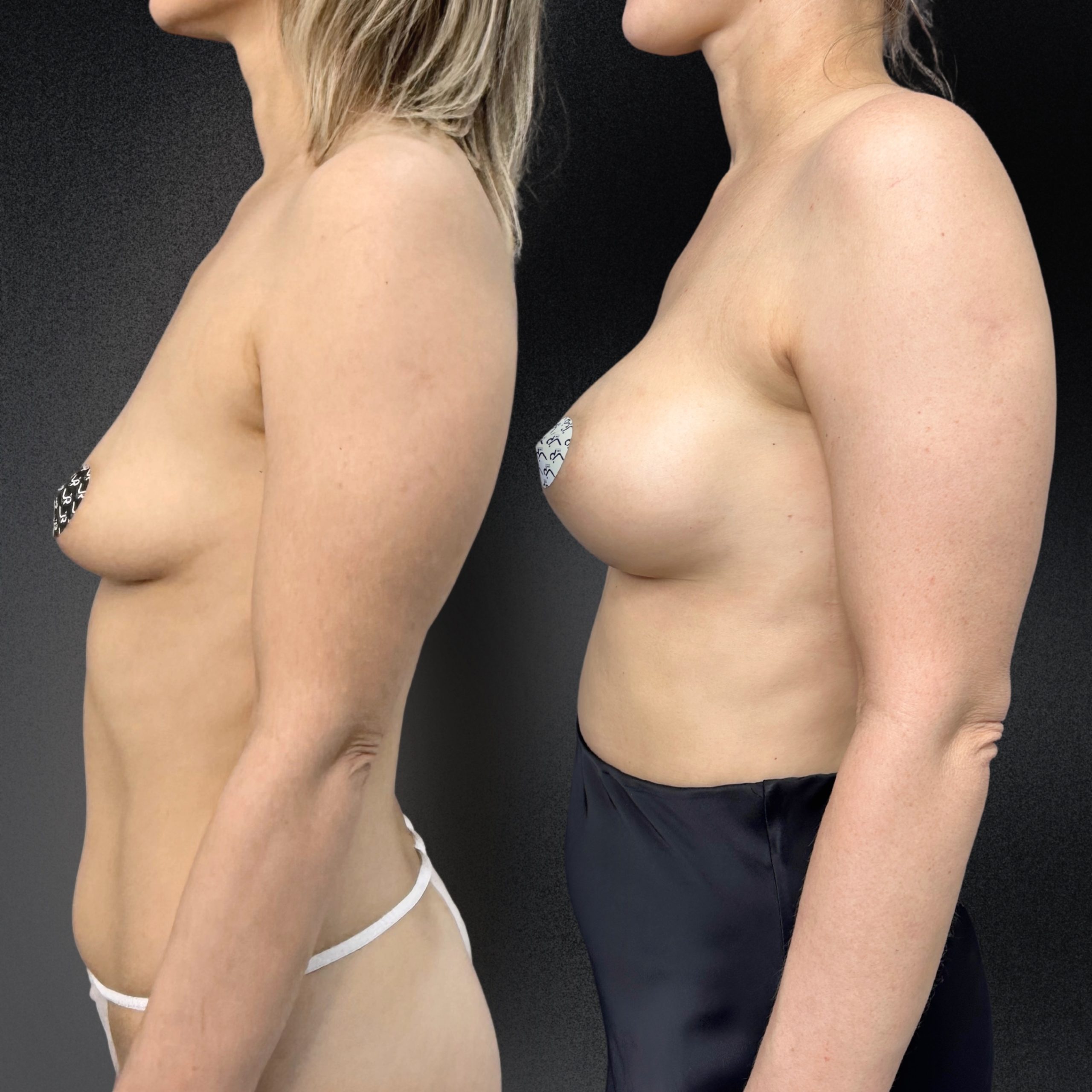 Подтяжка груди (мастопексия) 01