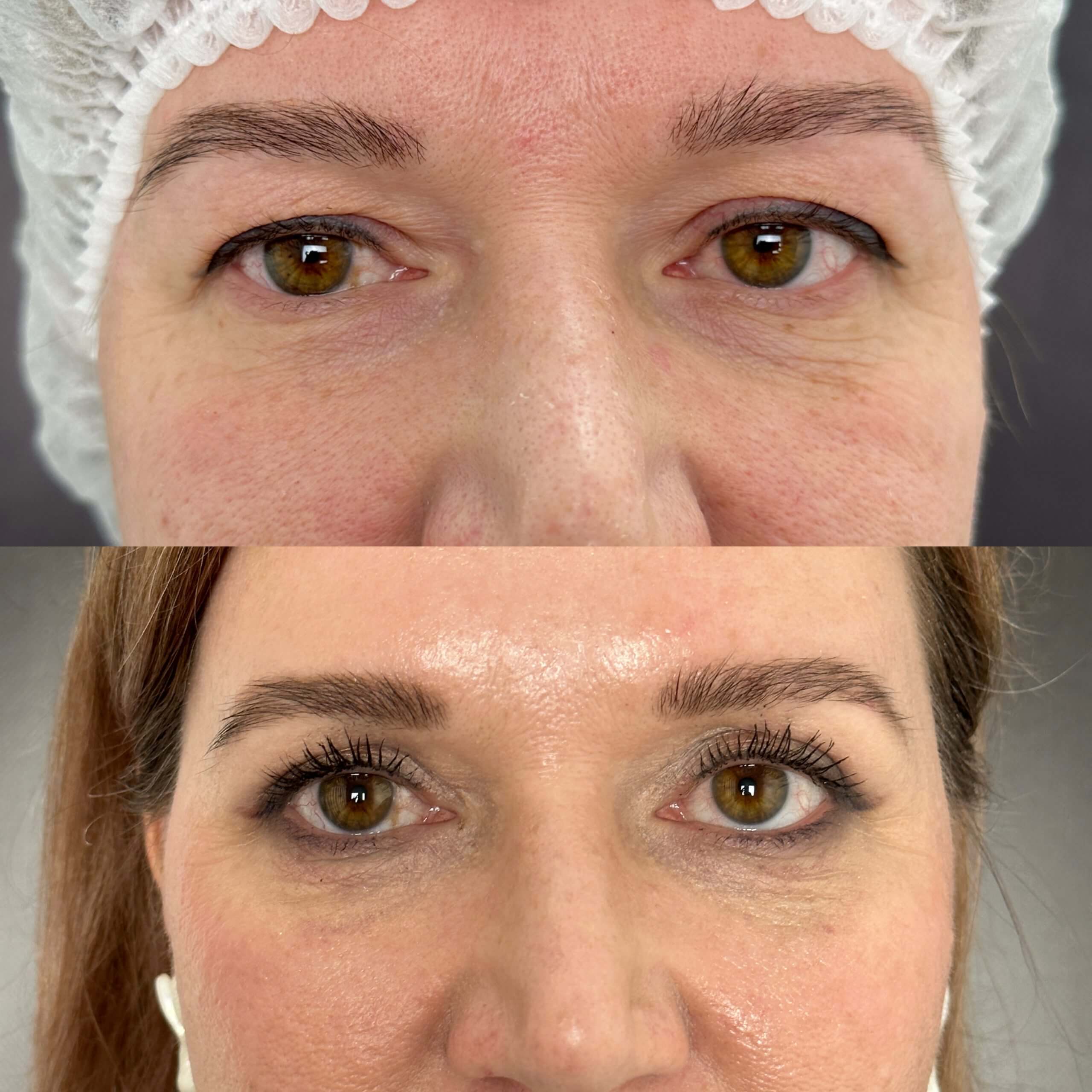 Нижняя блефаропластика 01