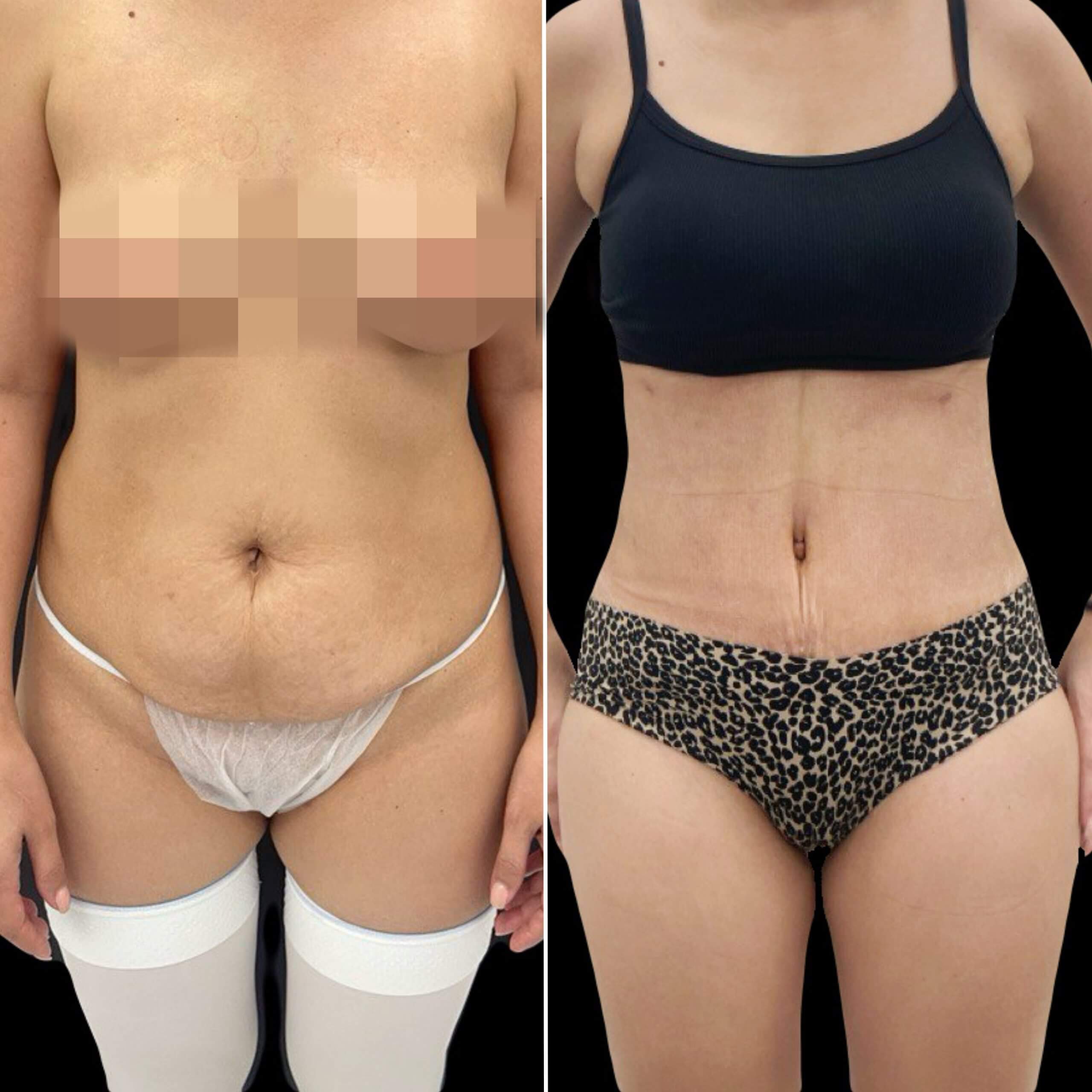 Абдоминопластика с переносом пупка 01