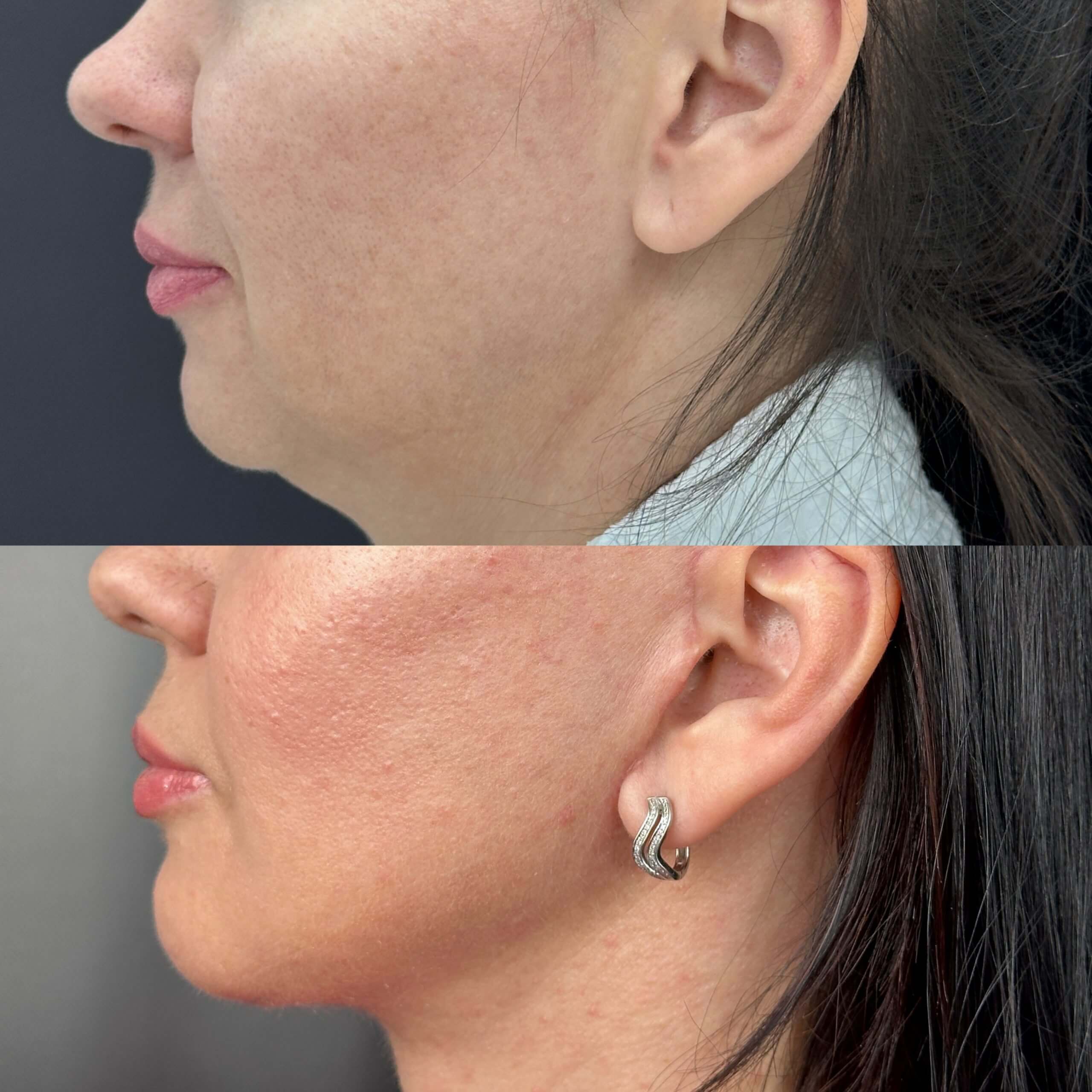 Липосакция подбородка и шеи 01