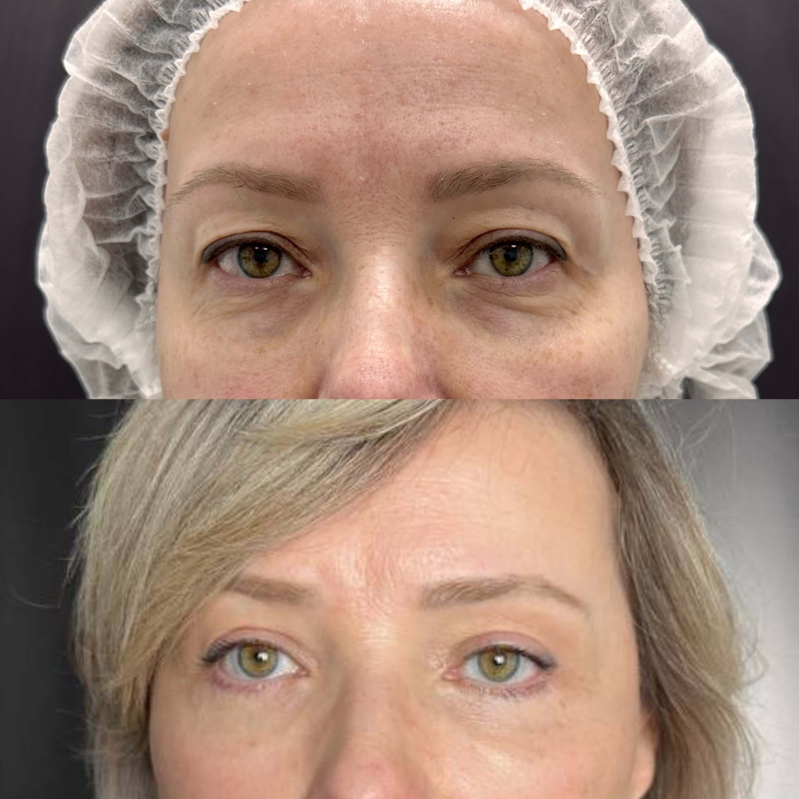 Нижняя блефаропластика 01