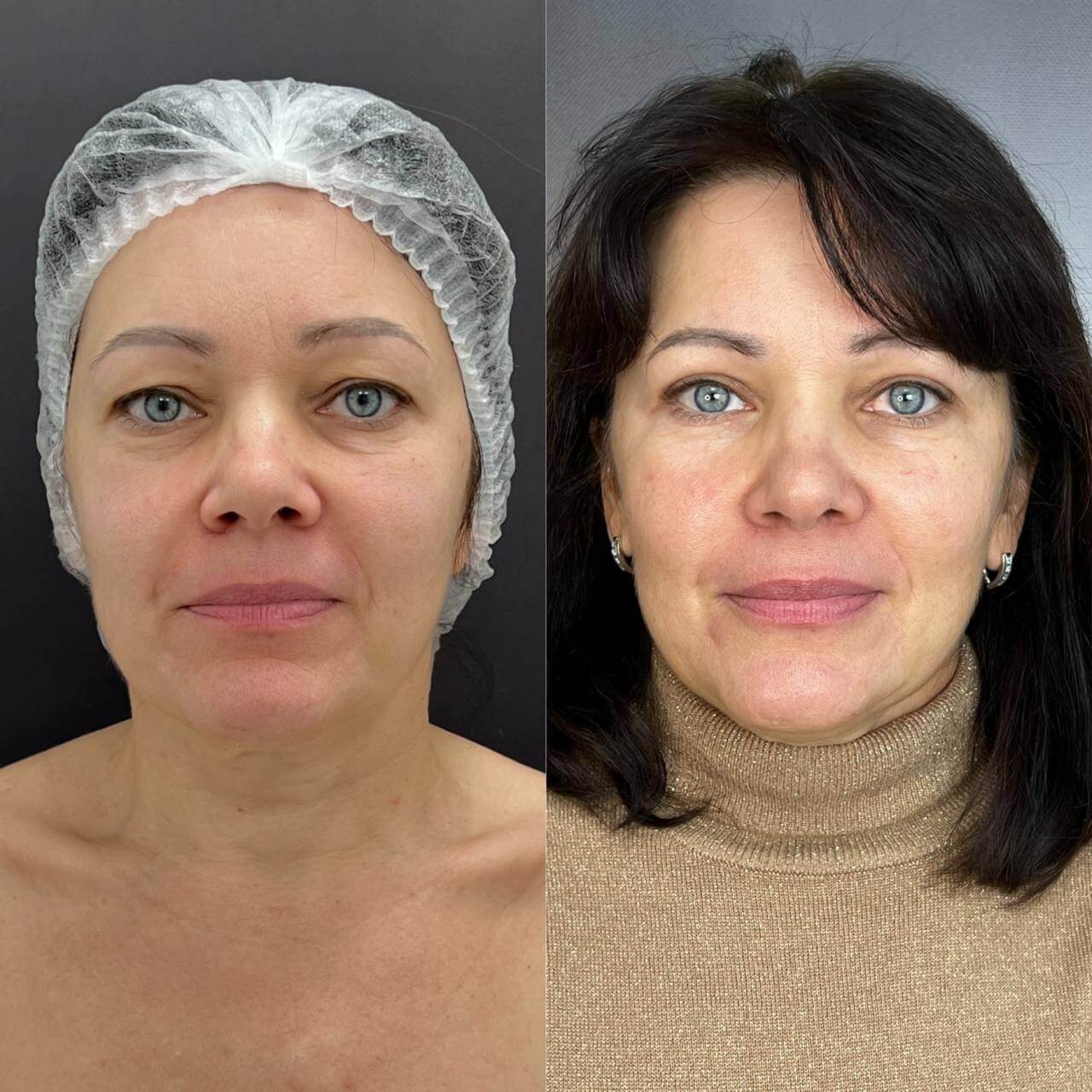 Нижняя блефаропластика 01