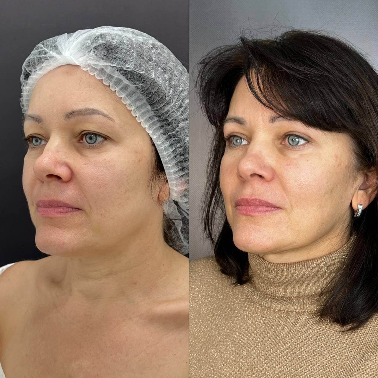 Нижняя блефаропластика 01