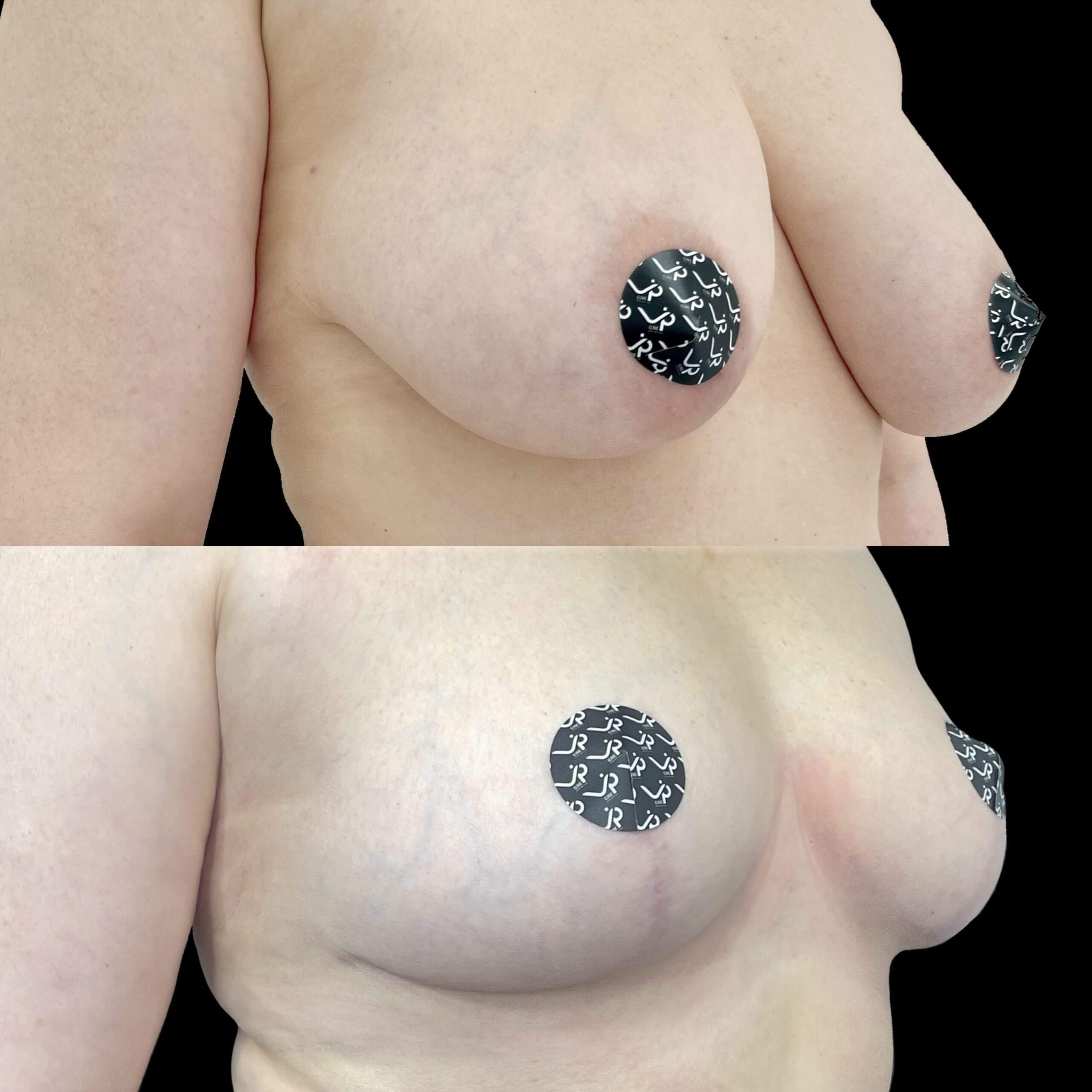 Подтяжка груди (мастопексия) 01