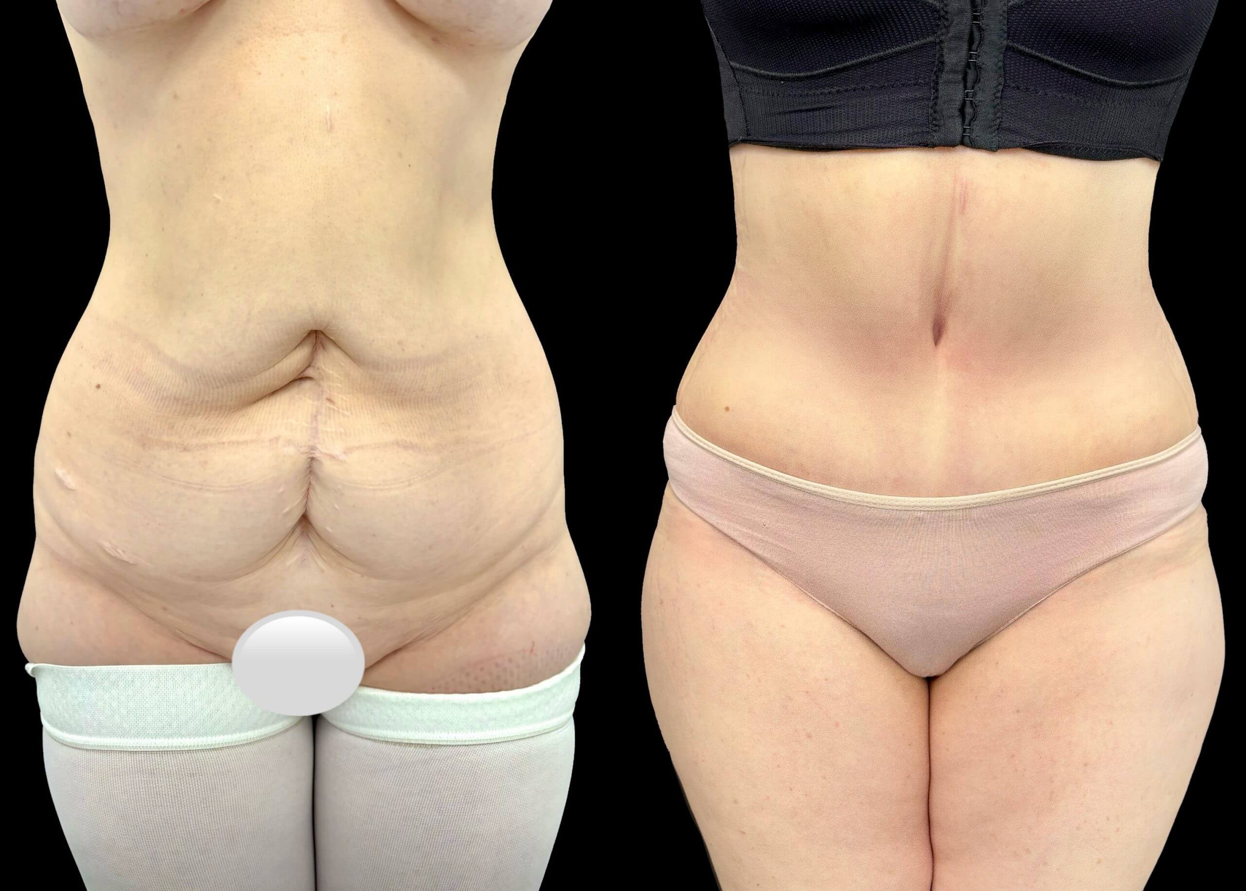 Миниабдоминопластика 01