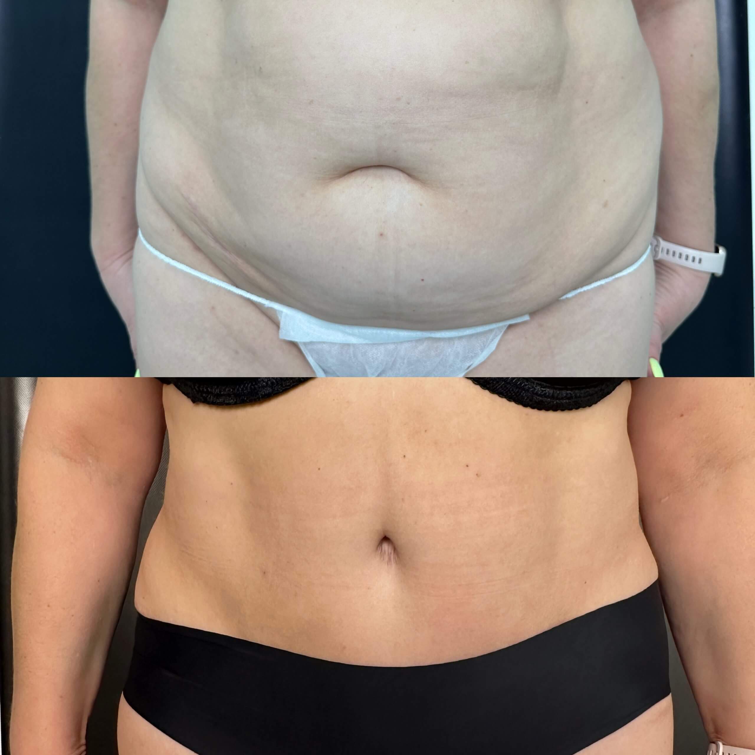 Ушивание диастаза 01