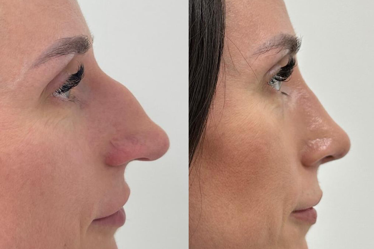 Ринопластика 01