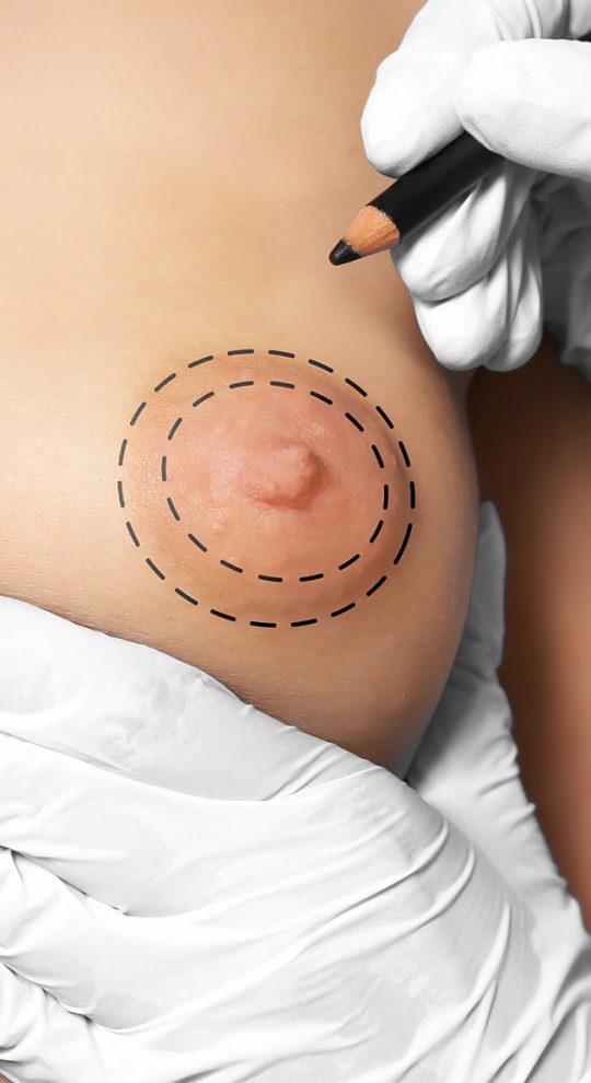 Коррекция ареол