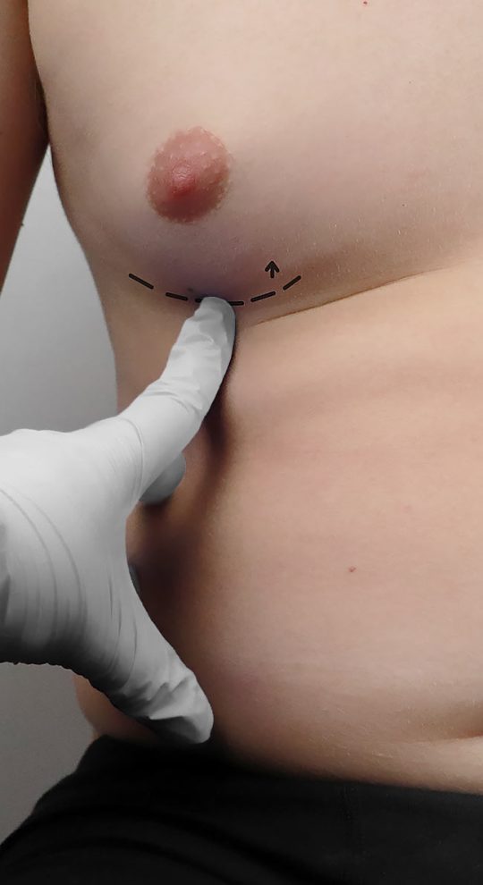 Коррекция гинекомастии