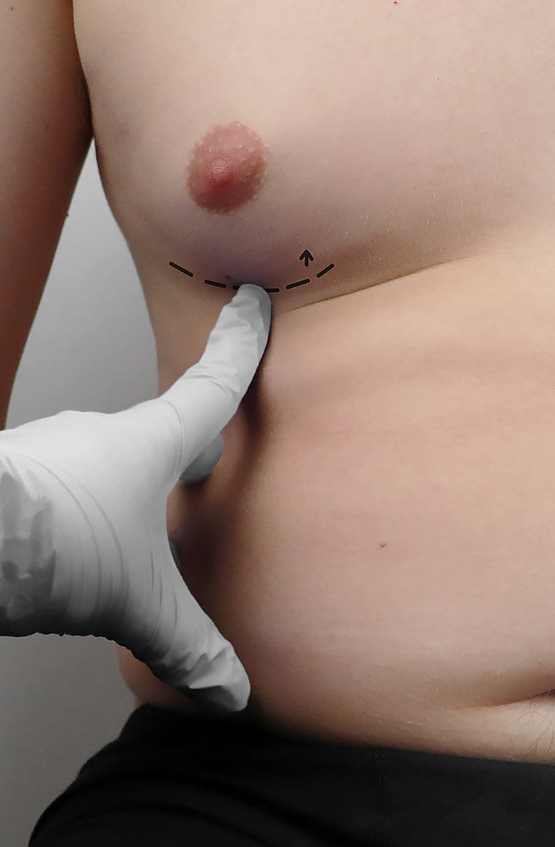 Коррекция гинекомастии