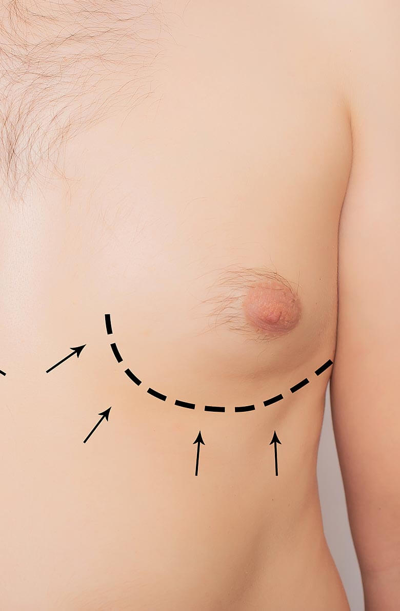 korrektsiya-ginekomastii-2