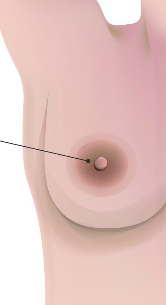 Коррекция сосков