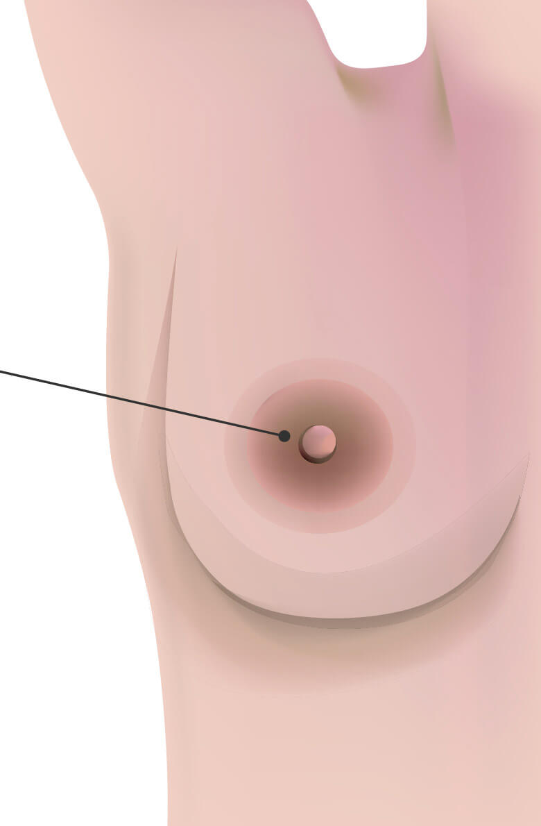 Коррекция сосков