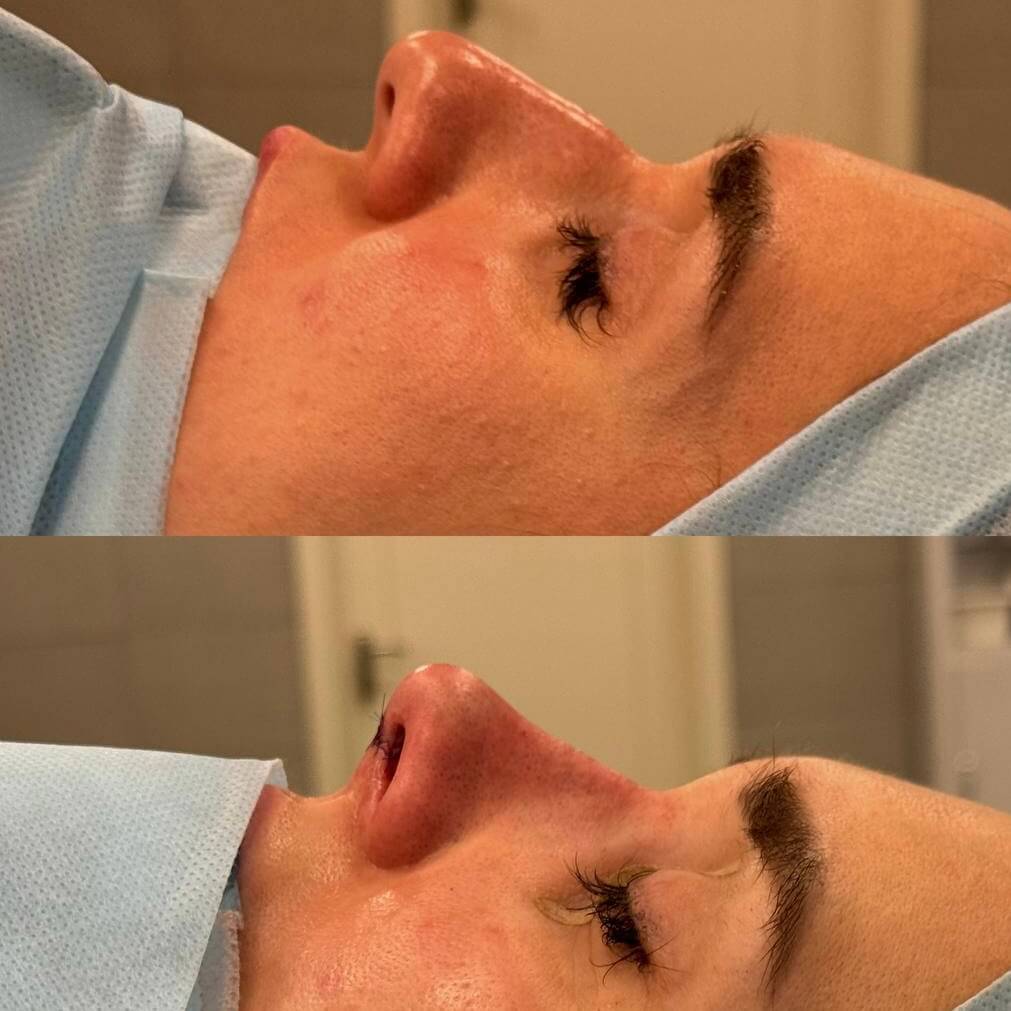 Ринопластика 01