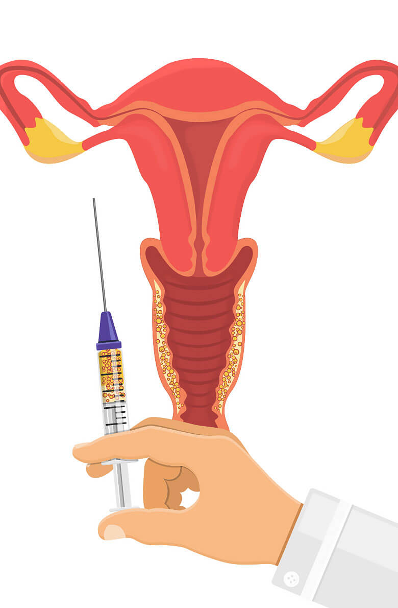 Липофилинг интимной зоны