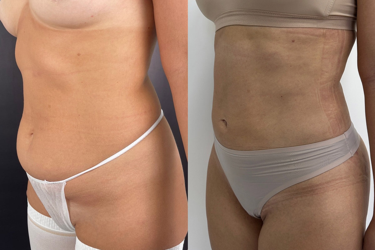 Липомоделирование тела 01