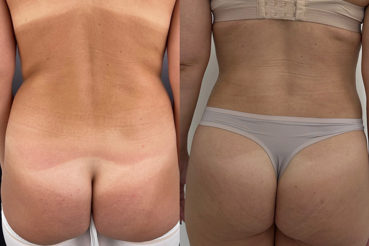 Липомоделирование тела 01