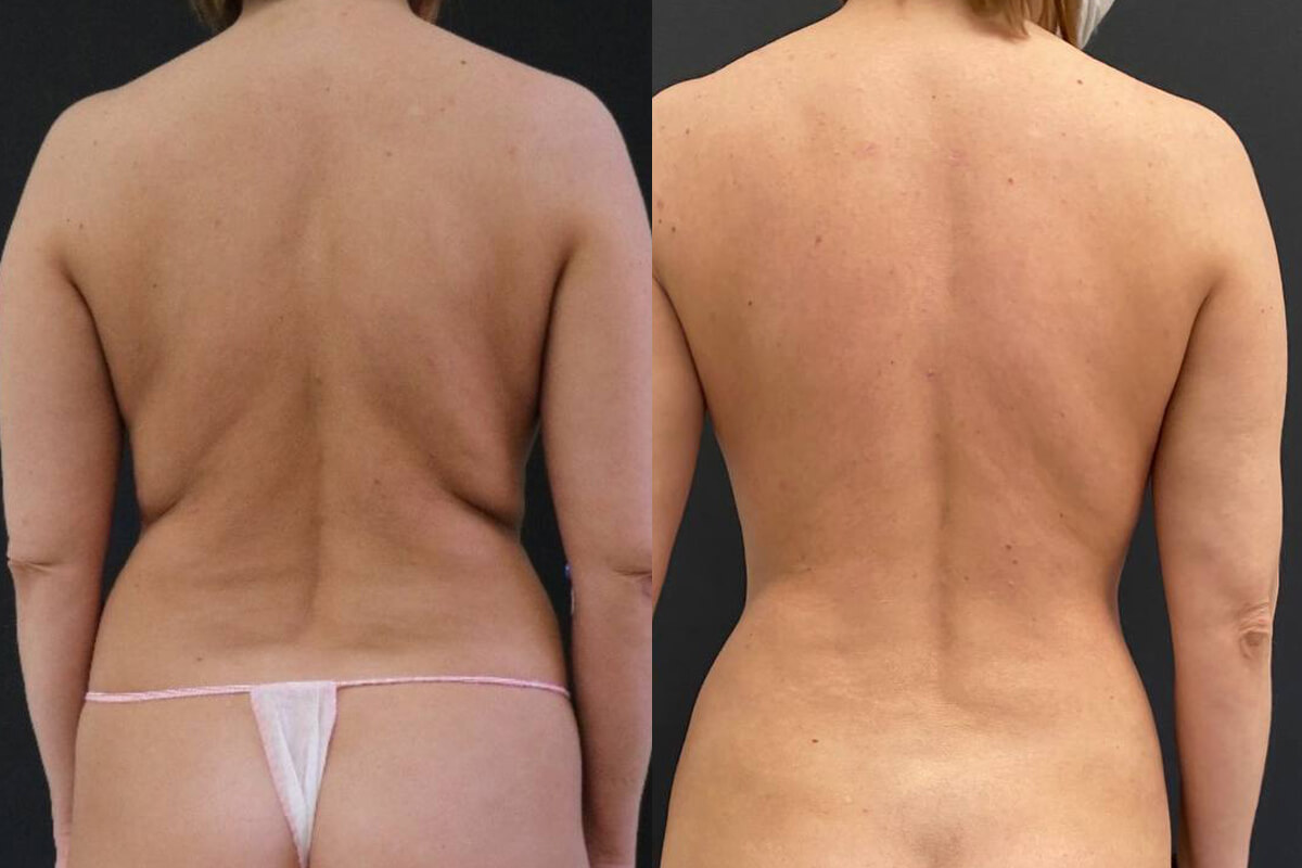 Липомоделирование тела 01