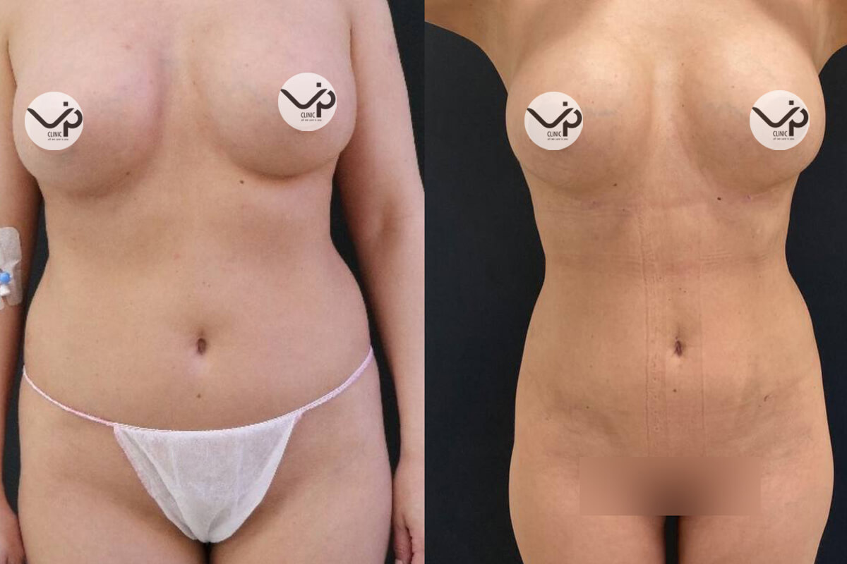 Липомоделирование тела 01